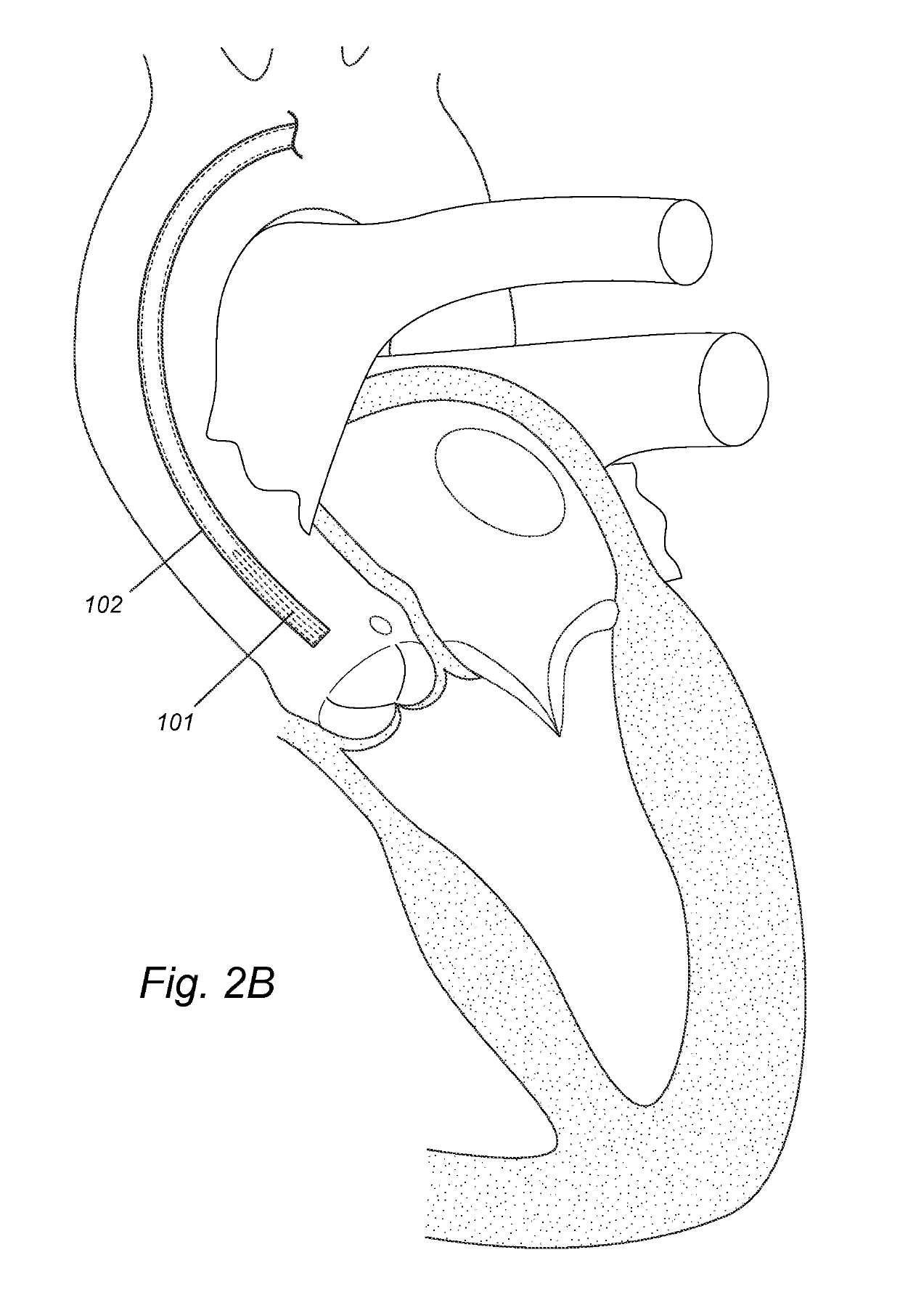 Pigtail for optimal aortic valvular complex imaging and alignment