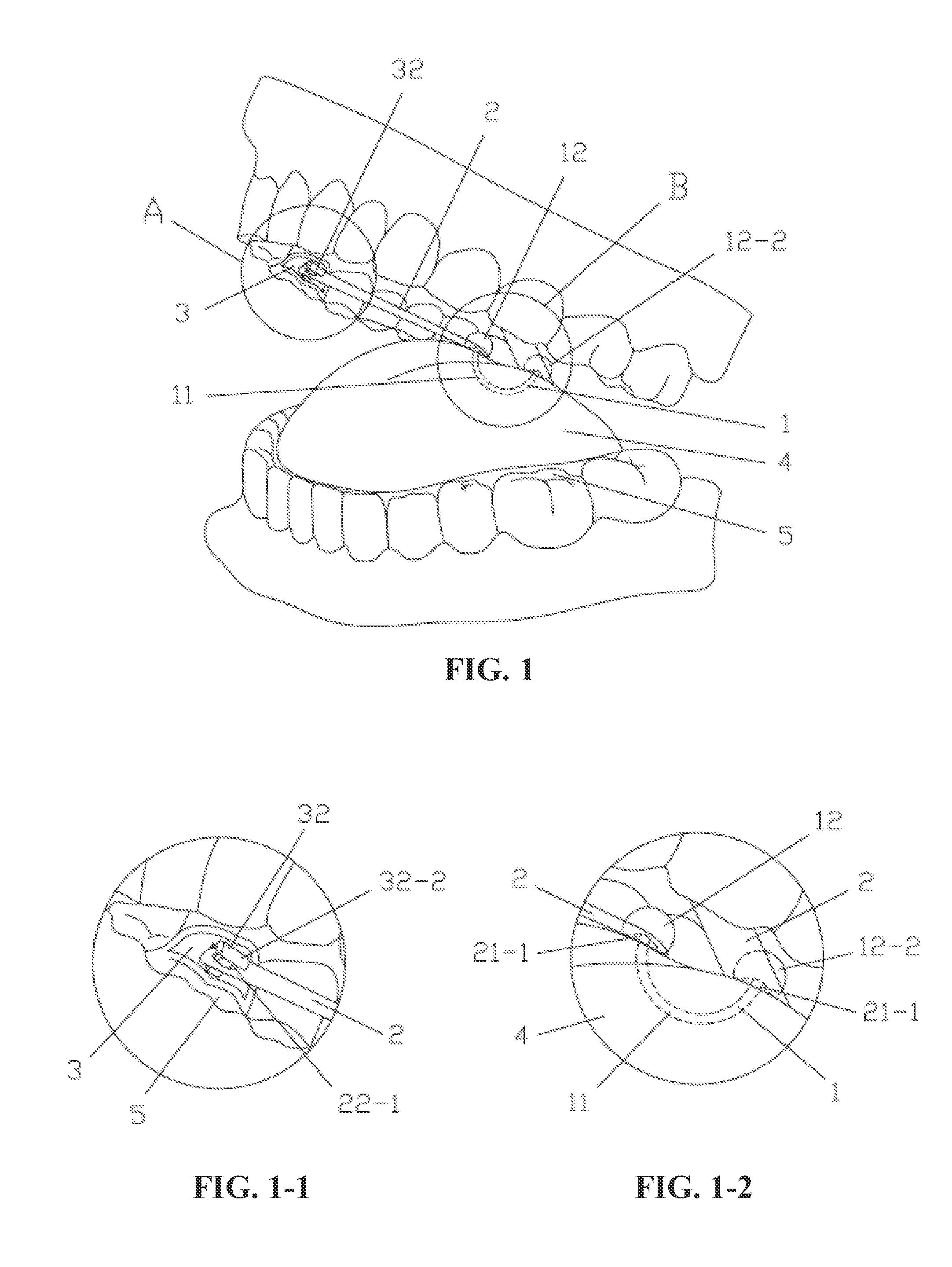 Elastic tongue-dorsum retraction device, clamping pliers, installation pliers, line guide and implantation method