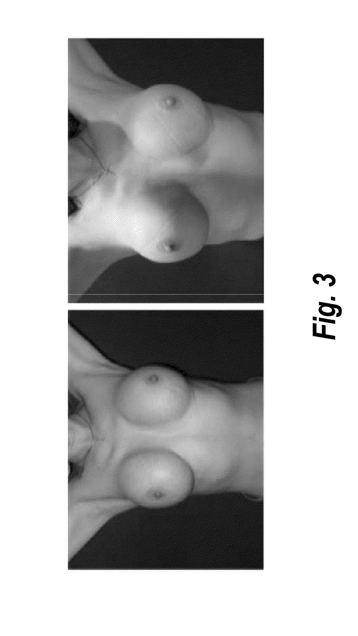 Process for the preparation of a pharmaceutical composition containing pirfenidone in sustained-release tablet form and its application in the regression of human chronic renal failure, breast capsular contracture and hepatic fibrosis