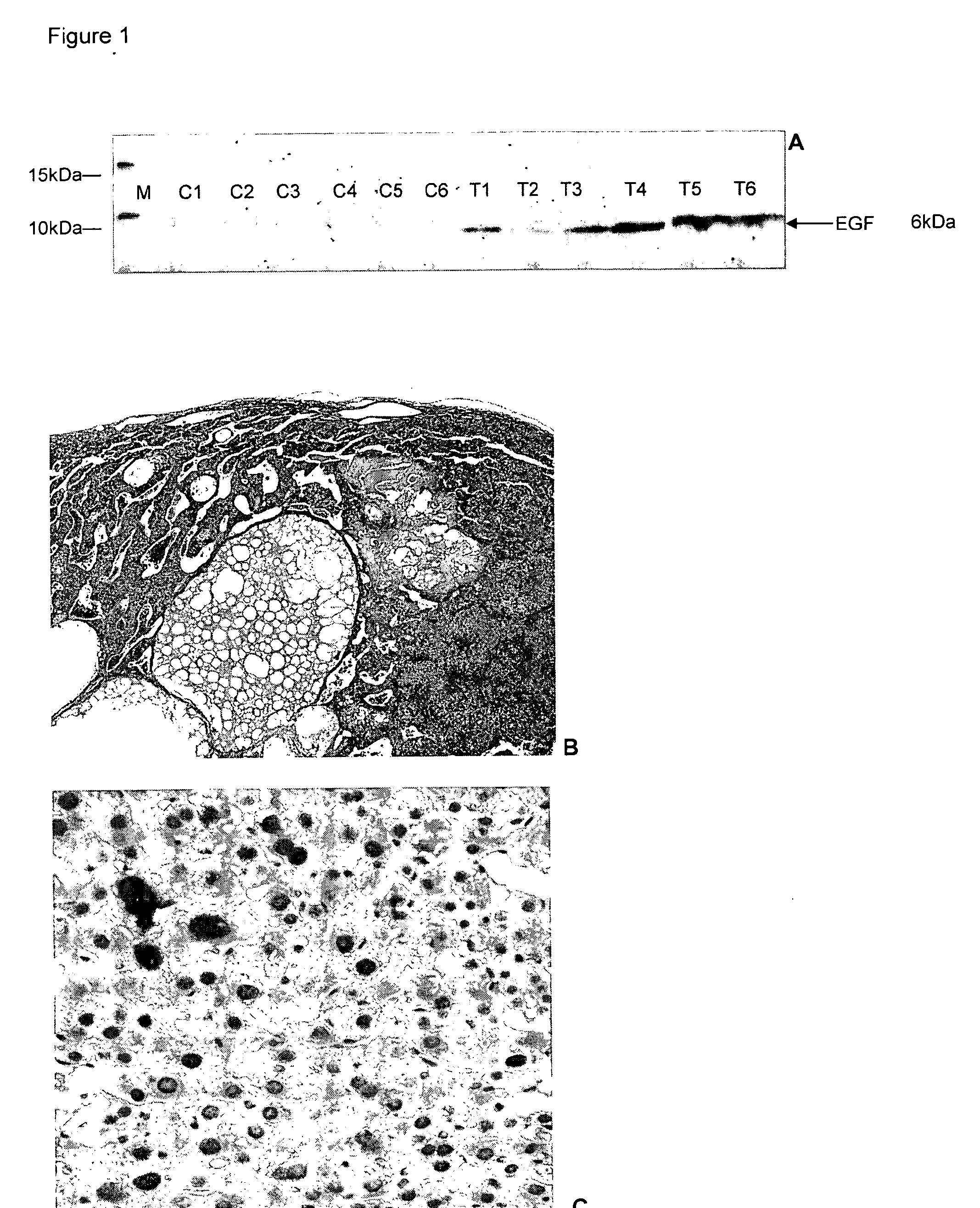 Serum proteomic for finding diagnostic markers and for monitoring therapeutical intervention in treatment of hepatocellular carcinoma