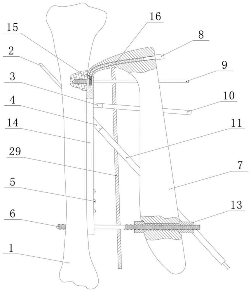 Navigation type minimally invasive bone setting system