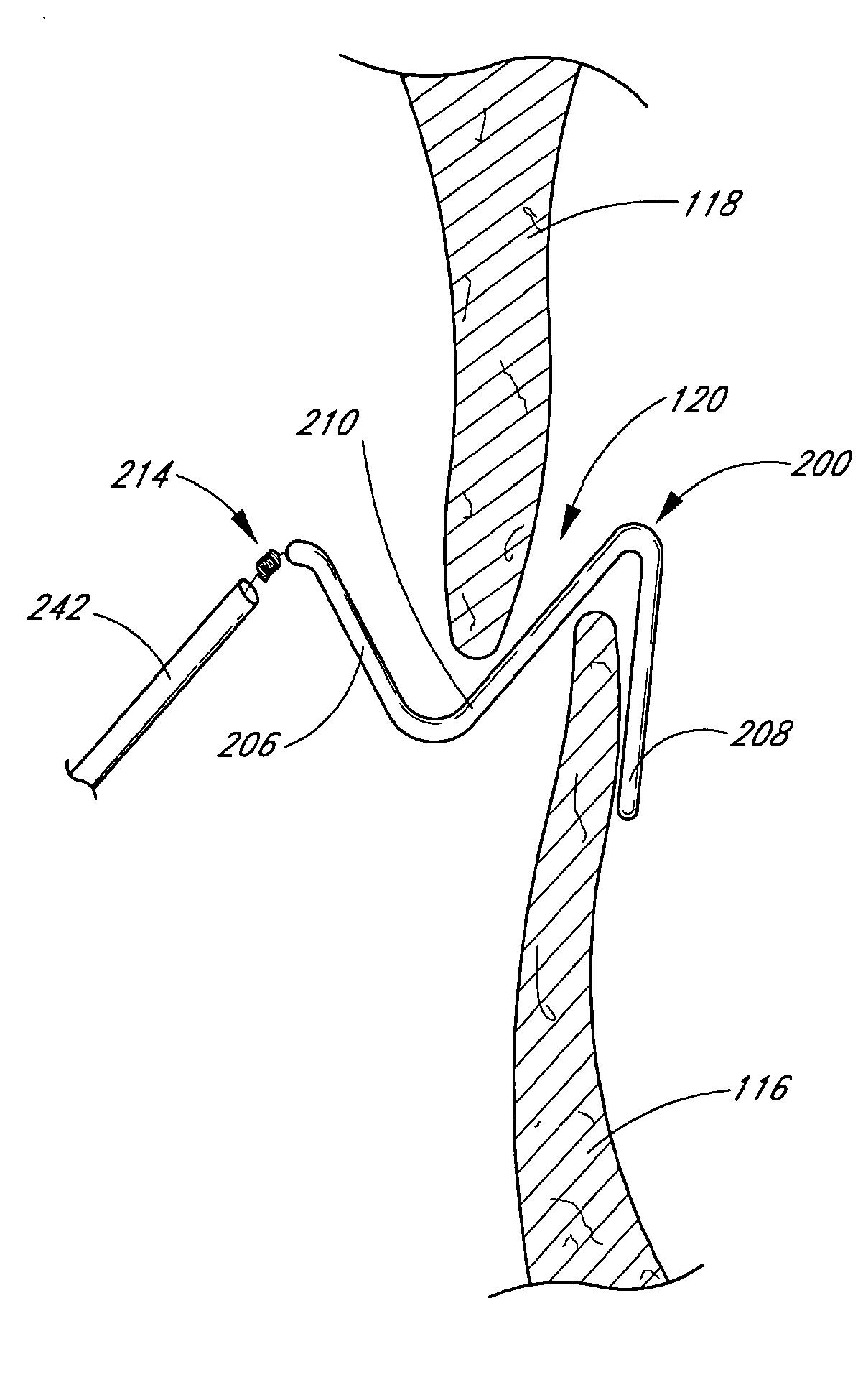 Patent foramen ovale closure system