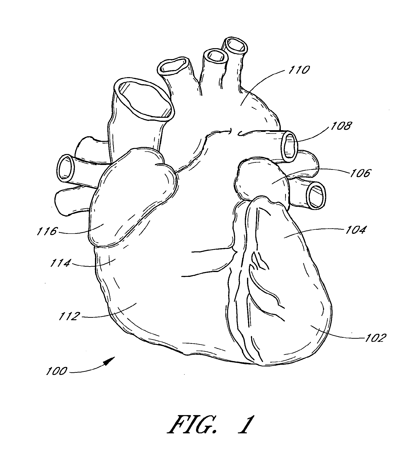 Patent foramen ovale closure system