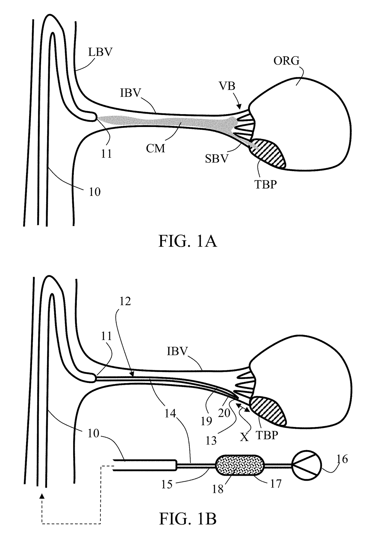 Embolization microcatheter