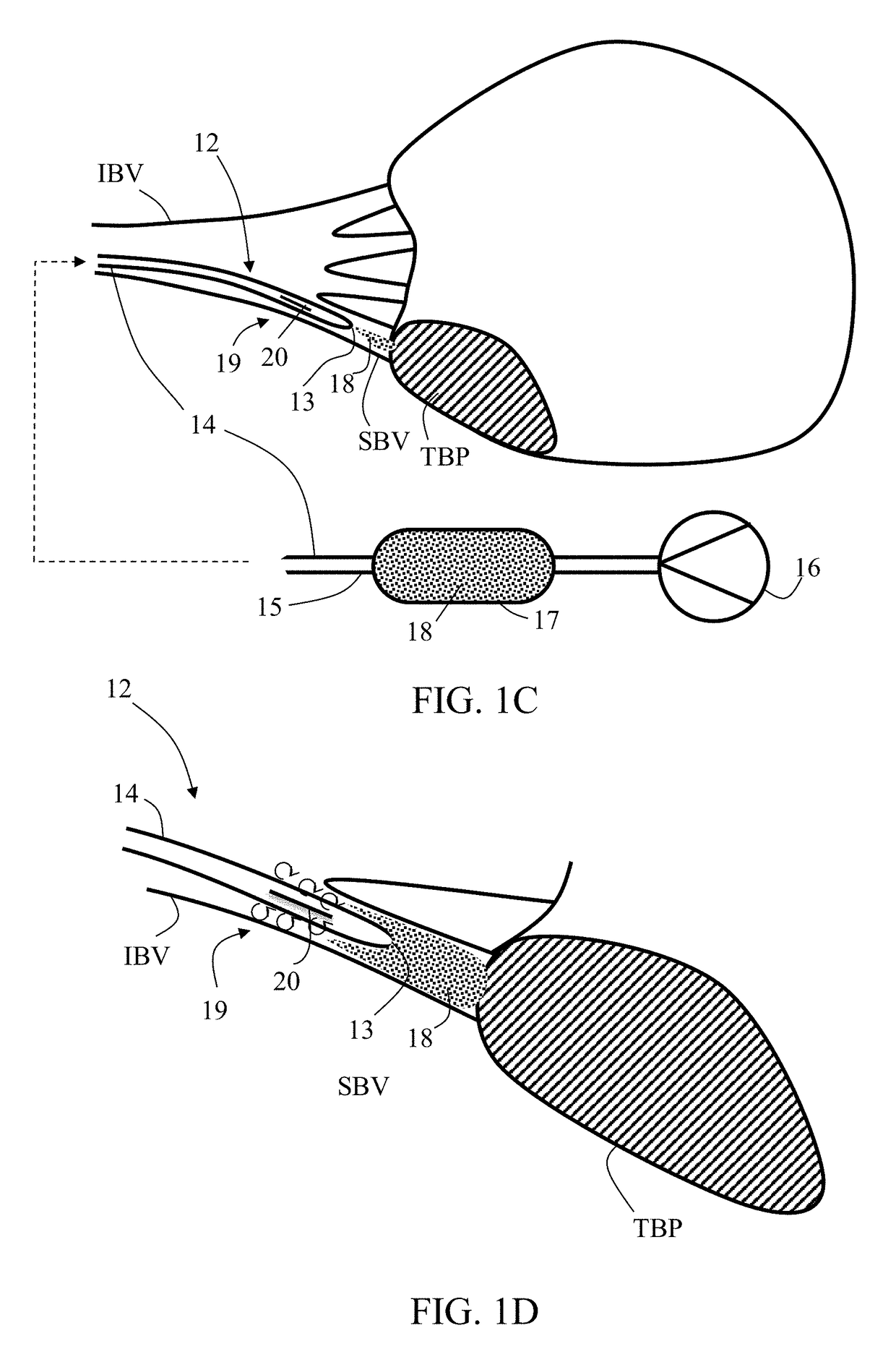 Embolization microcatheter