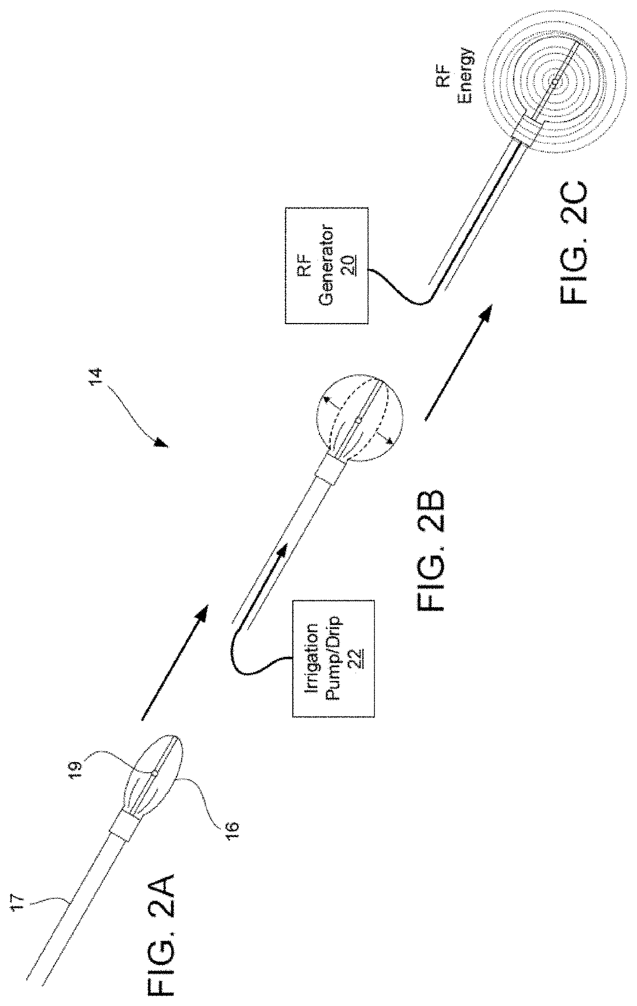 Cavitary tissue ablation