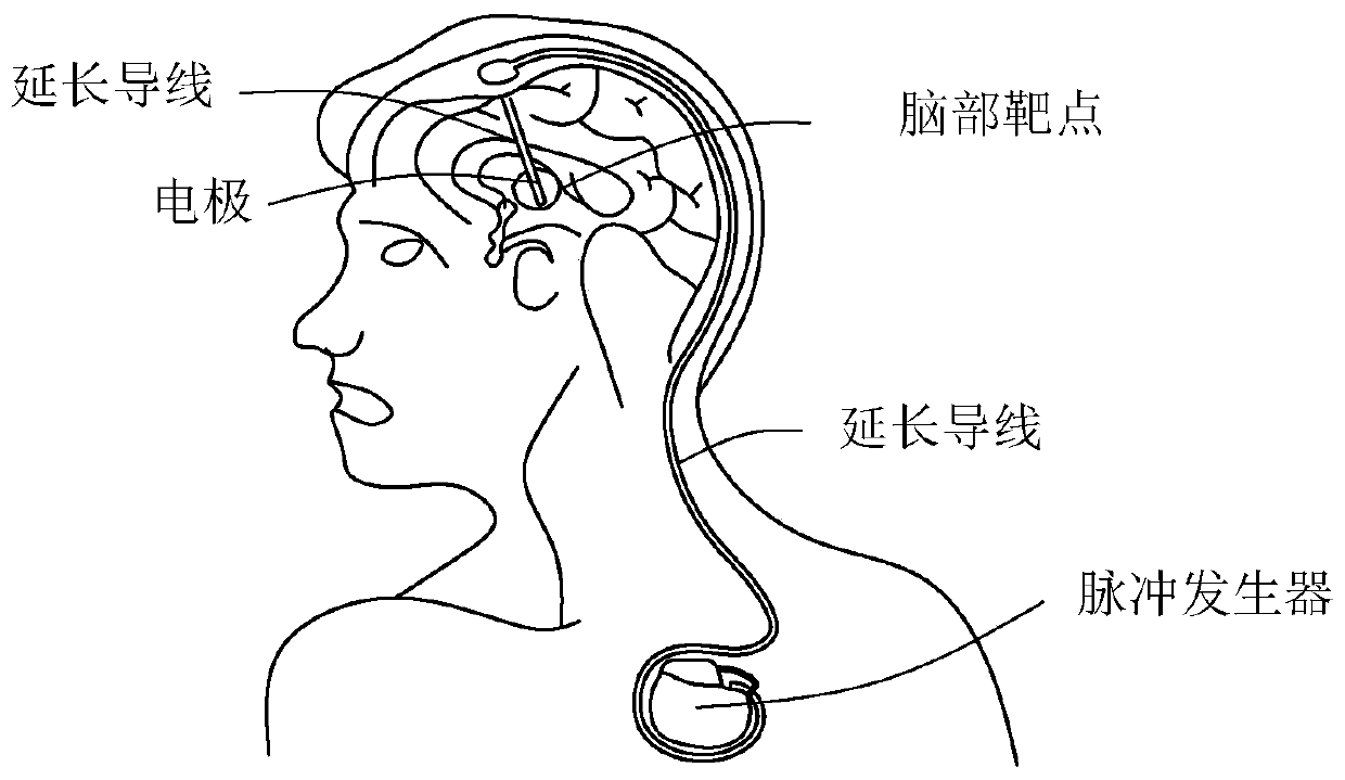 Electricity monitoring method and electric quantity monitoring system of a brain pacemaker