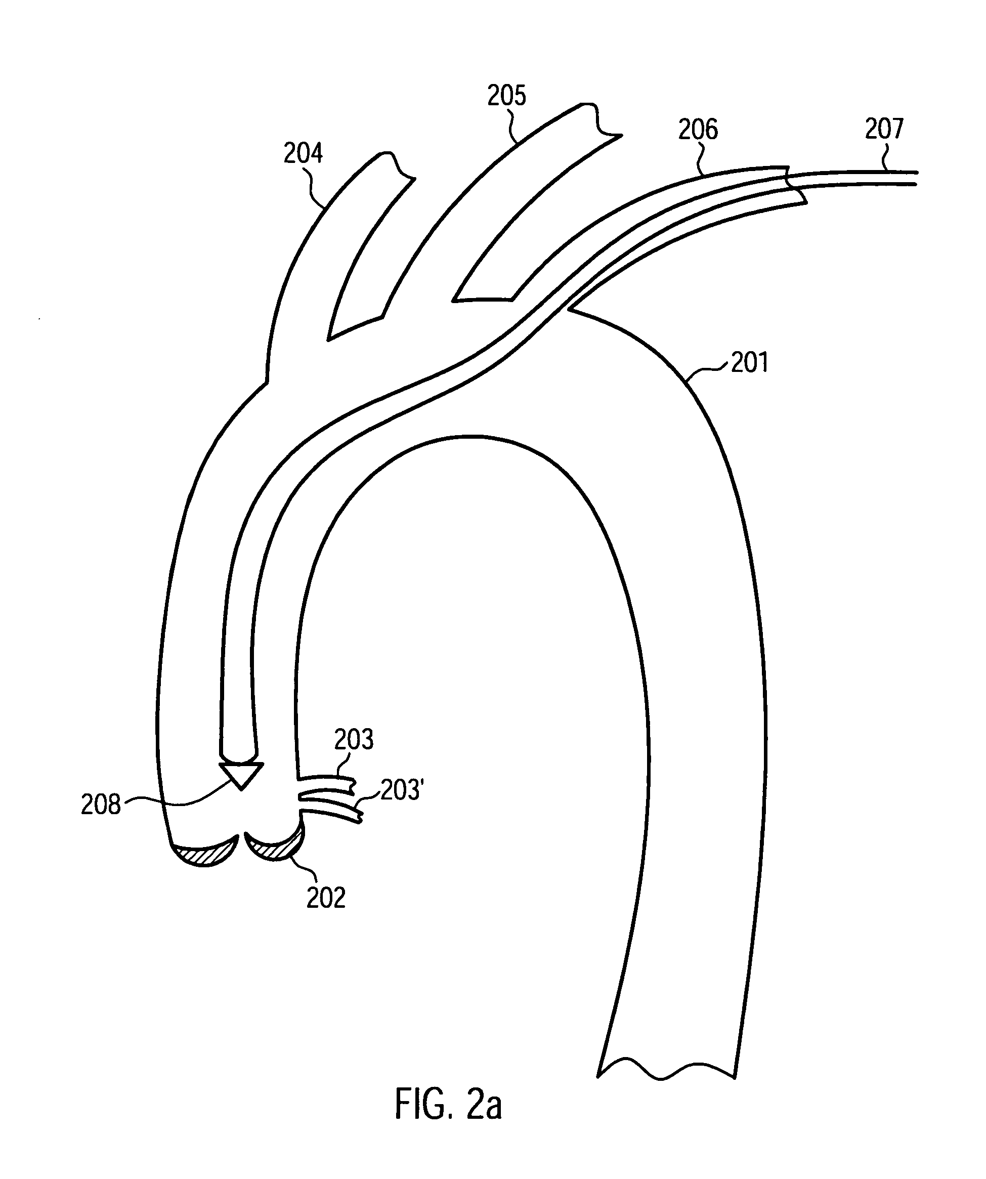 Cardiac assist device