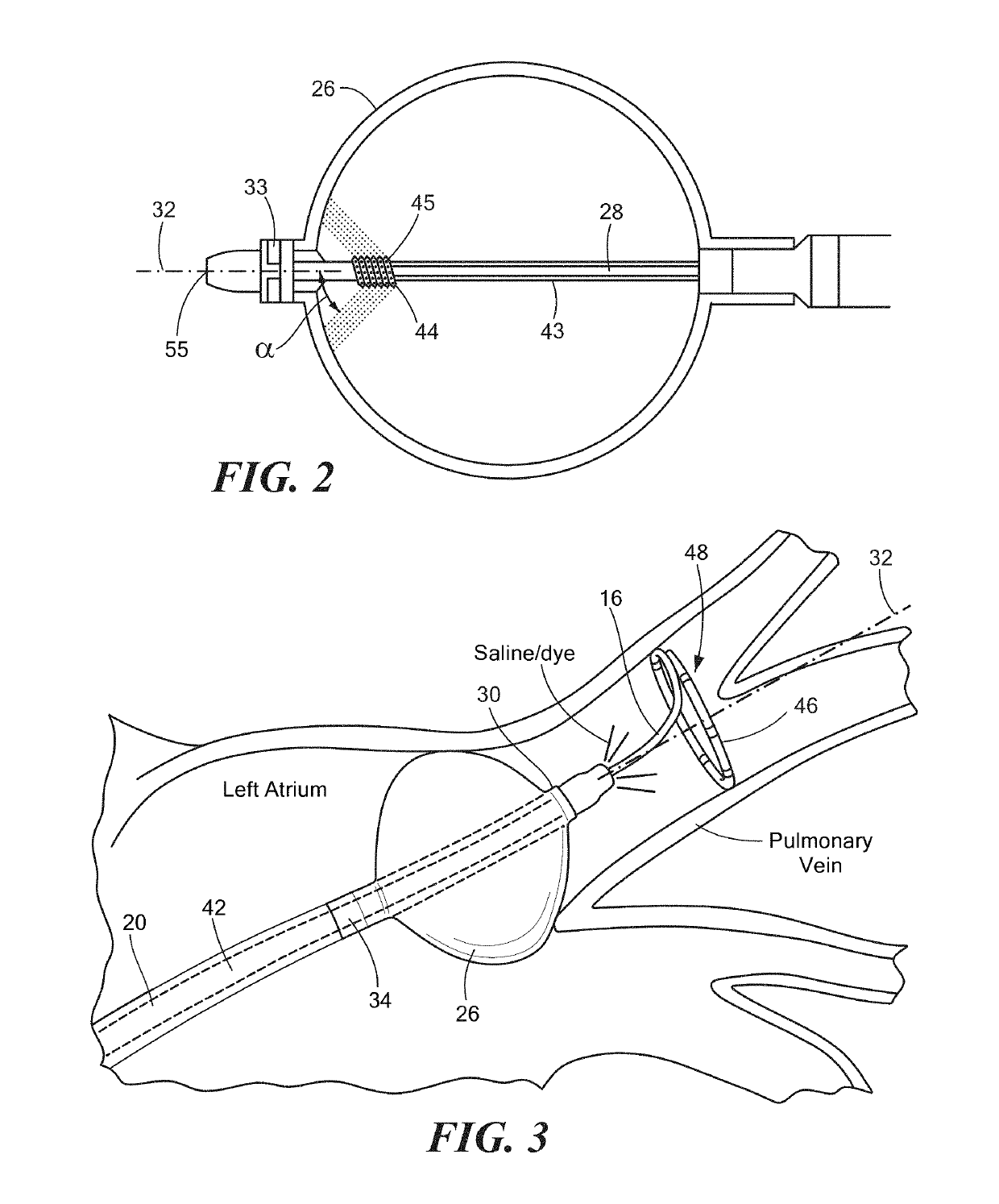 Determination of pulmonary vein and other vascular occlusion using temperature profile following cold saline injection