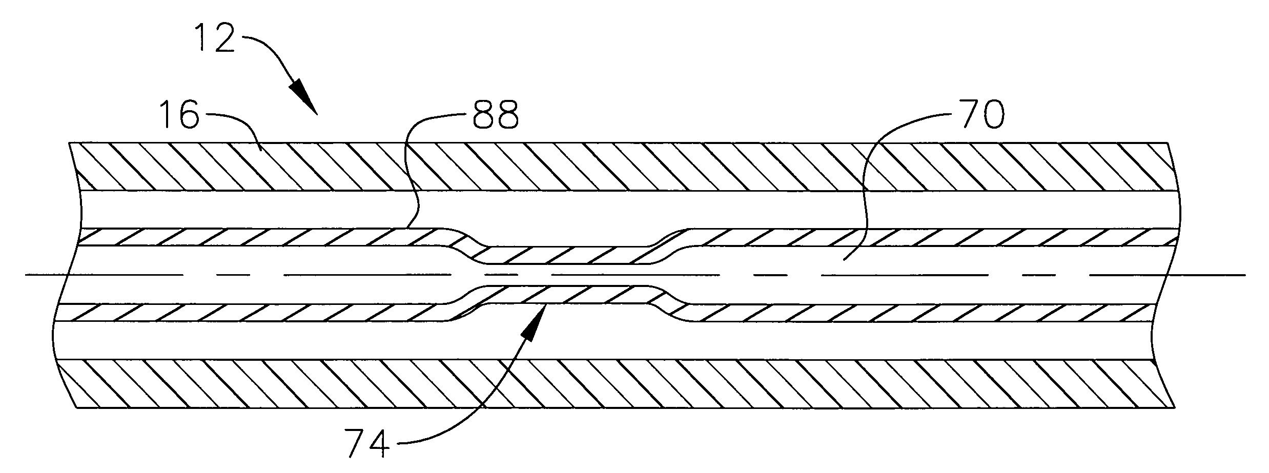 Loop structure including inflatable therapeutic device