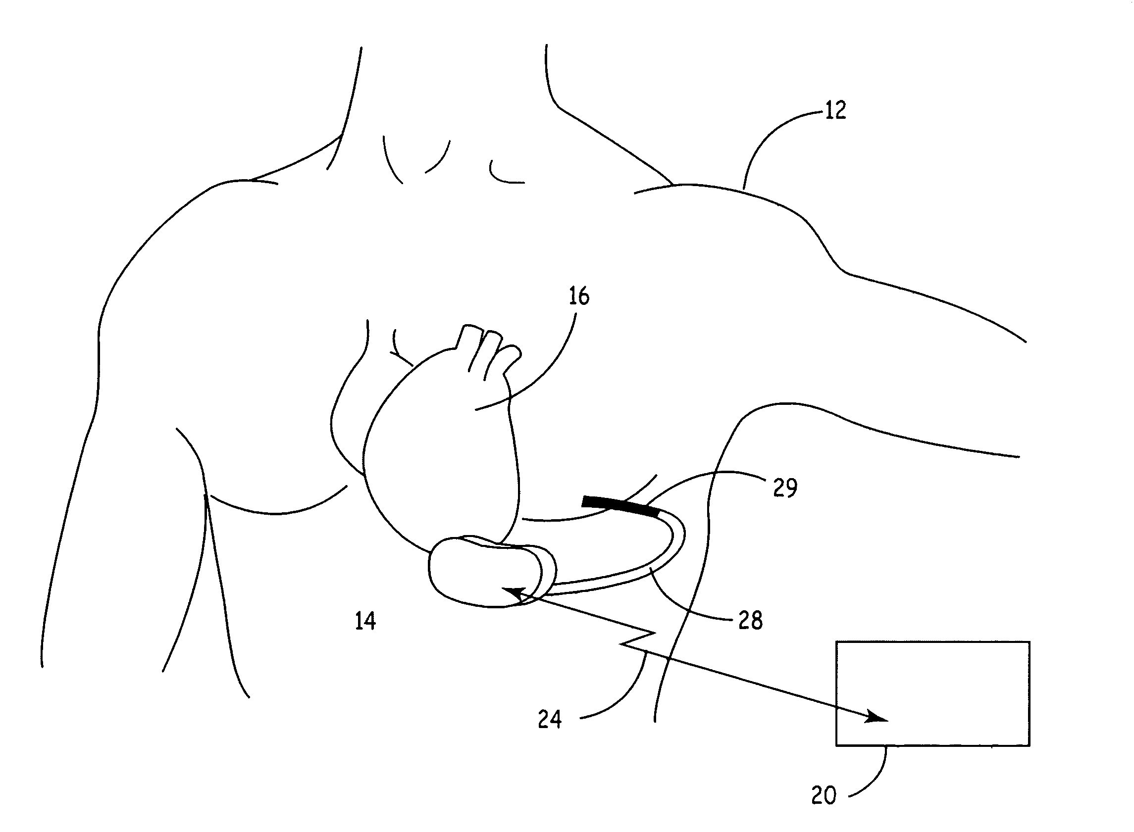 Level crossing detector for detecting noise, sinus rhythm and ventricular fibrillation in subcutaneous or body surface signals