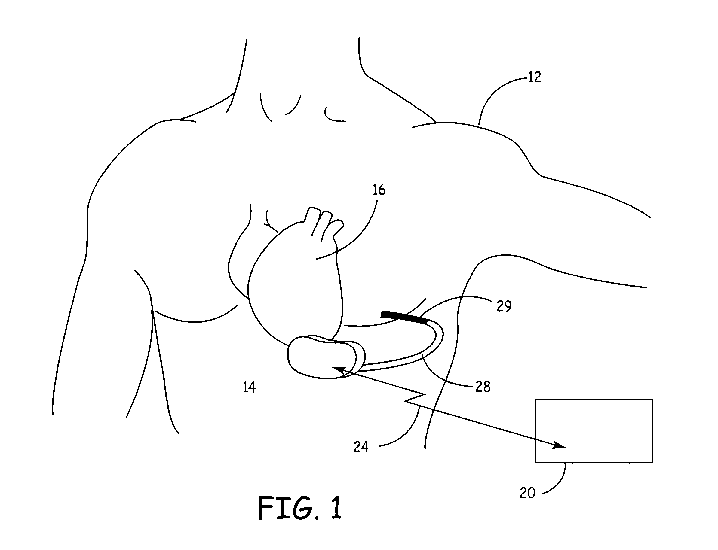 Level crossing detector for detecting noise, sinus rhythm and ventricular fibrillation in subcutaneous or body surface signals