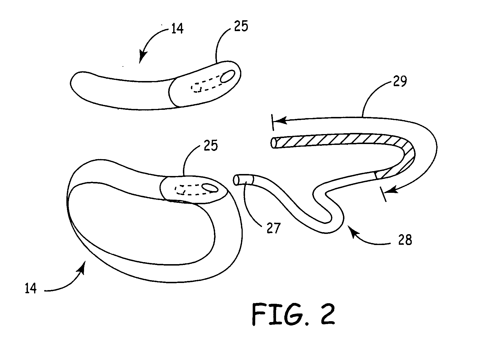 Level crossing detector for detecting noise, sinus rhythm and ventricular fibrillation in subcutaneous or body surface signals