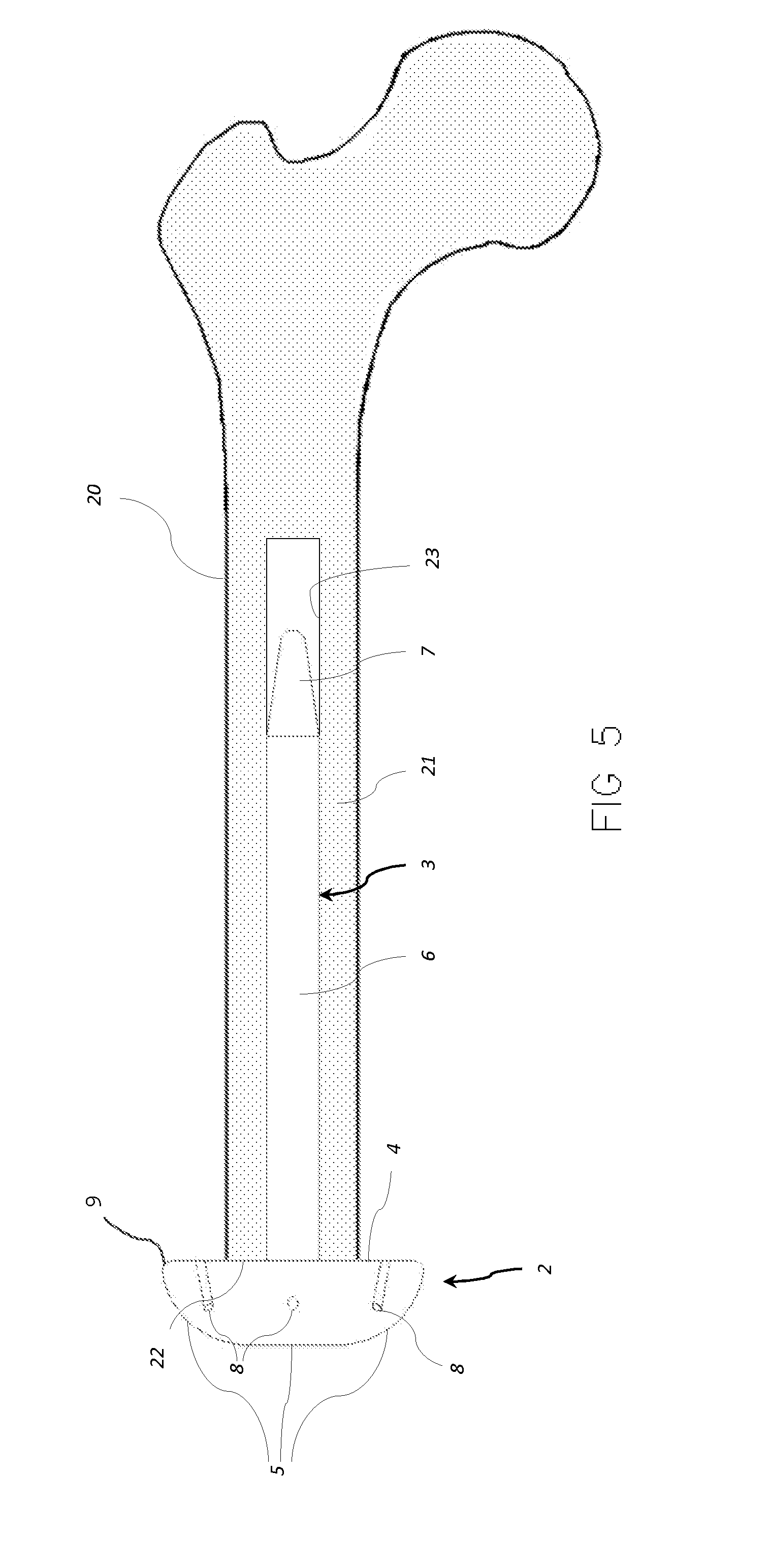 Implant for lower limb amputation