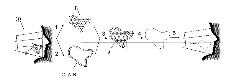 Complex-shaped gel-metal composite prosthesis and manufacturing method thereof