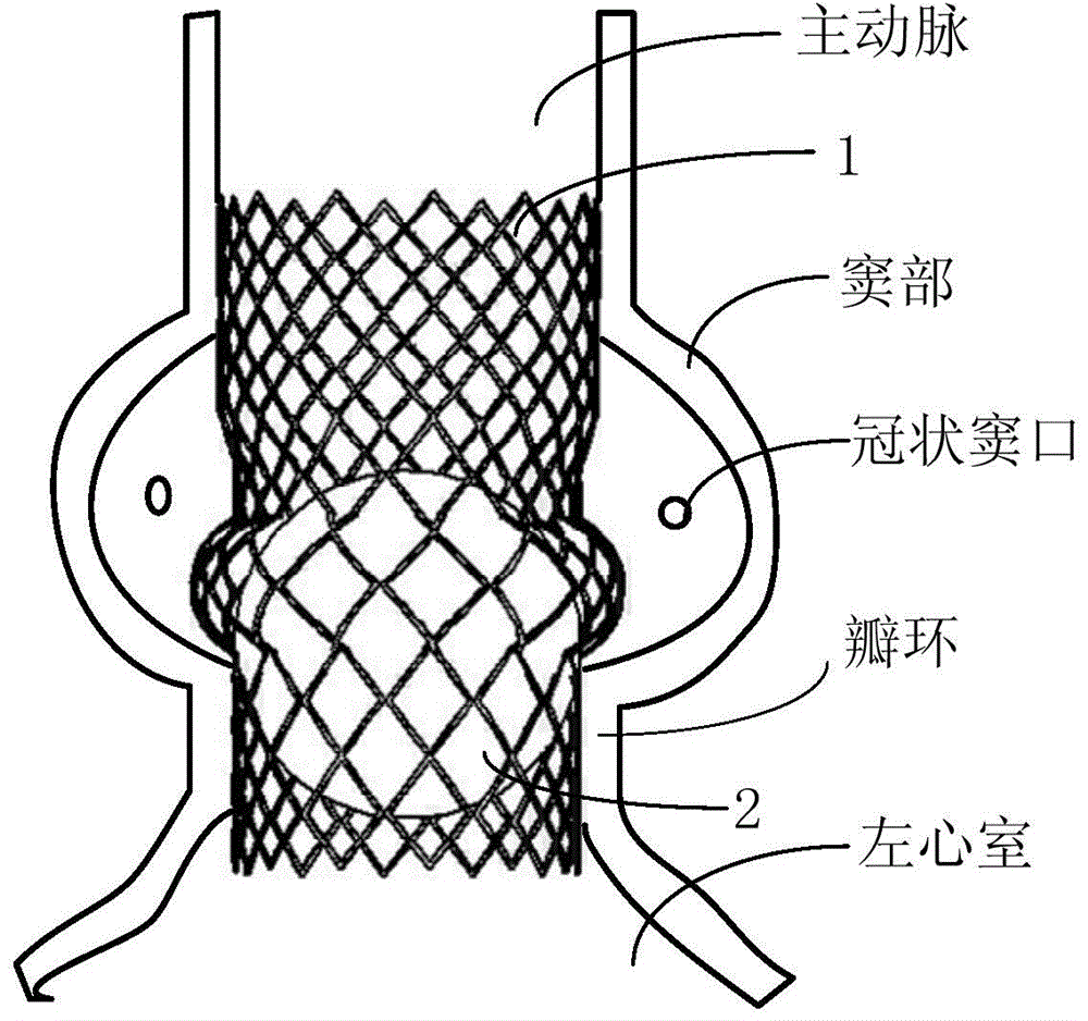 A liquid-filled cage ball type aortic valve stent system