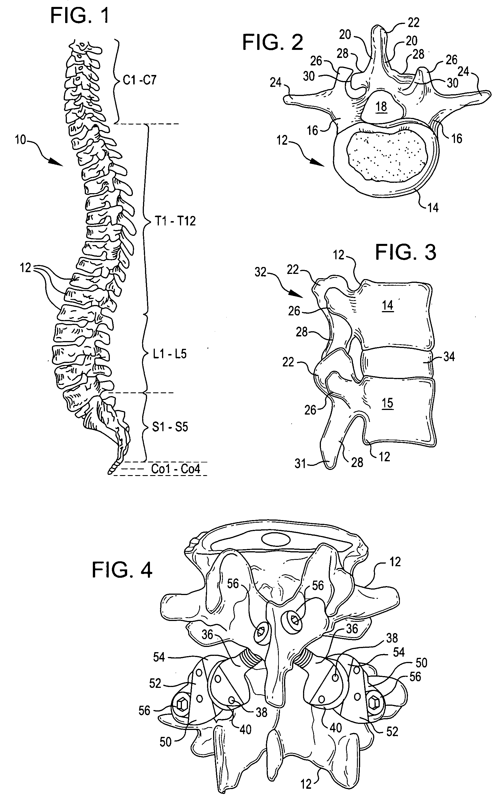 Crossbar spinal prosthesis having a modular design and related implantation methods