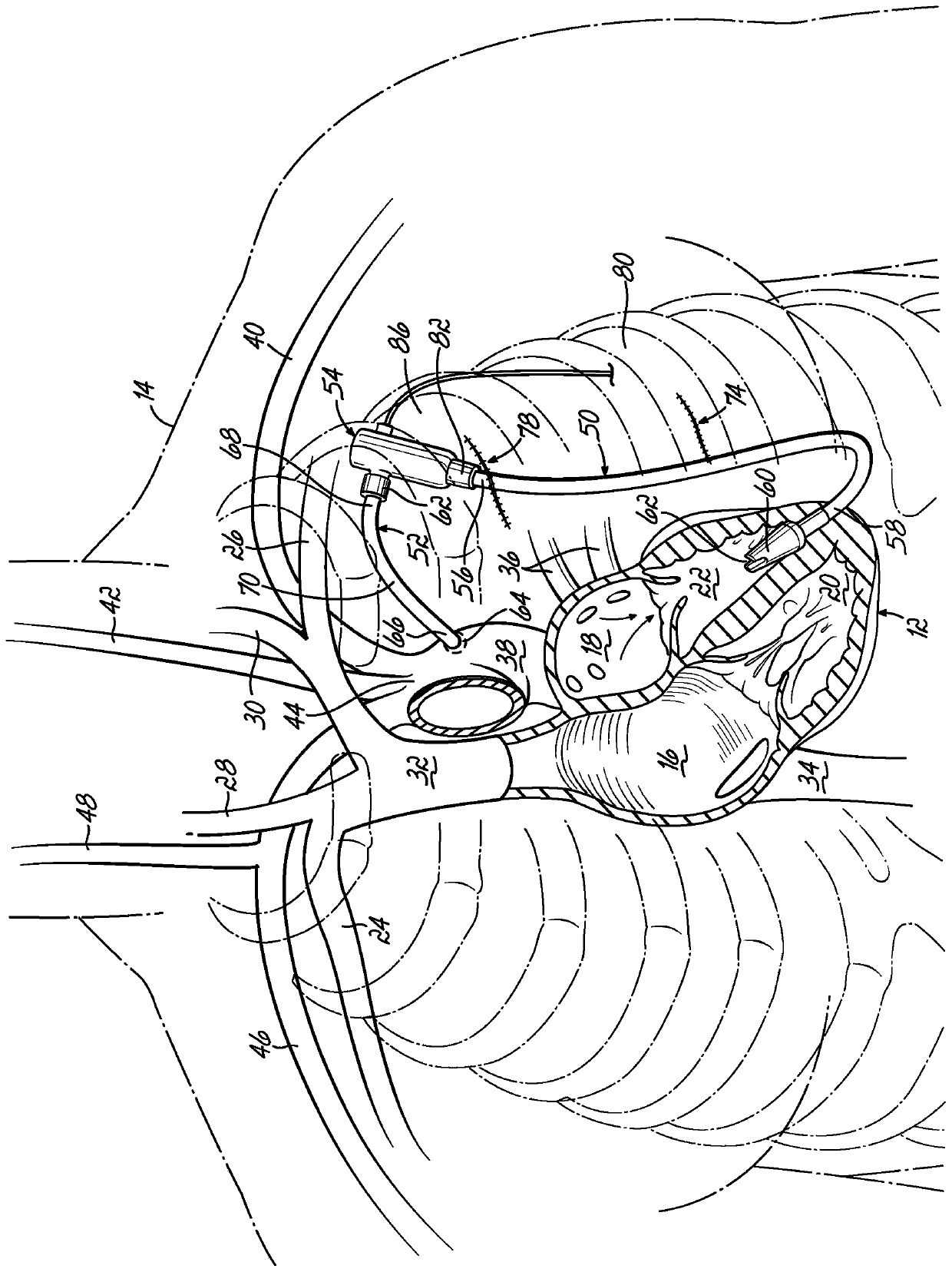 Inflow cannula tunneling tool allowing quick exchange with dilation plug