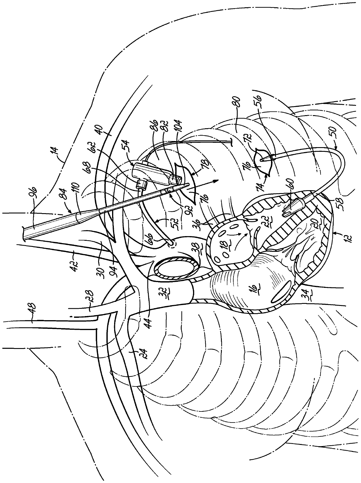 Inflow cannula tunneling tool allowing quick exchange with dilation plug