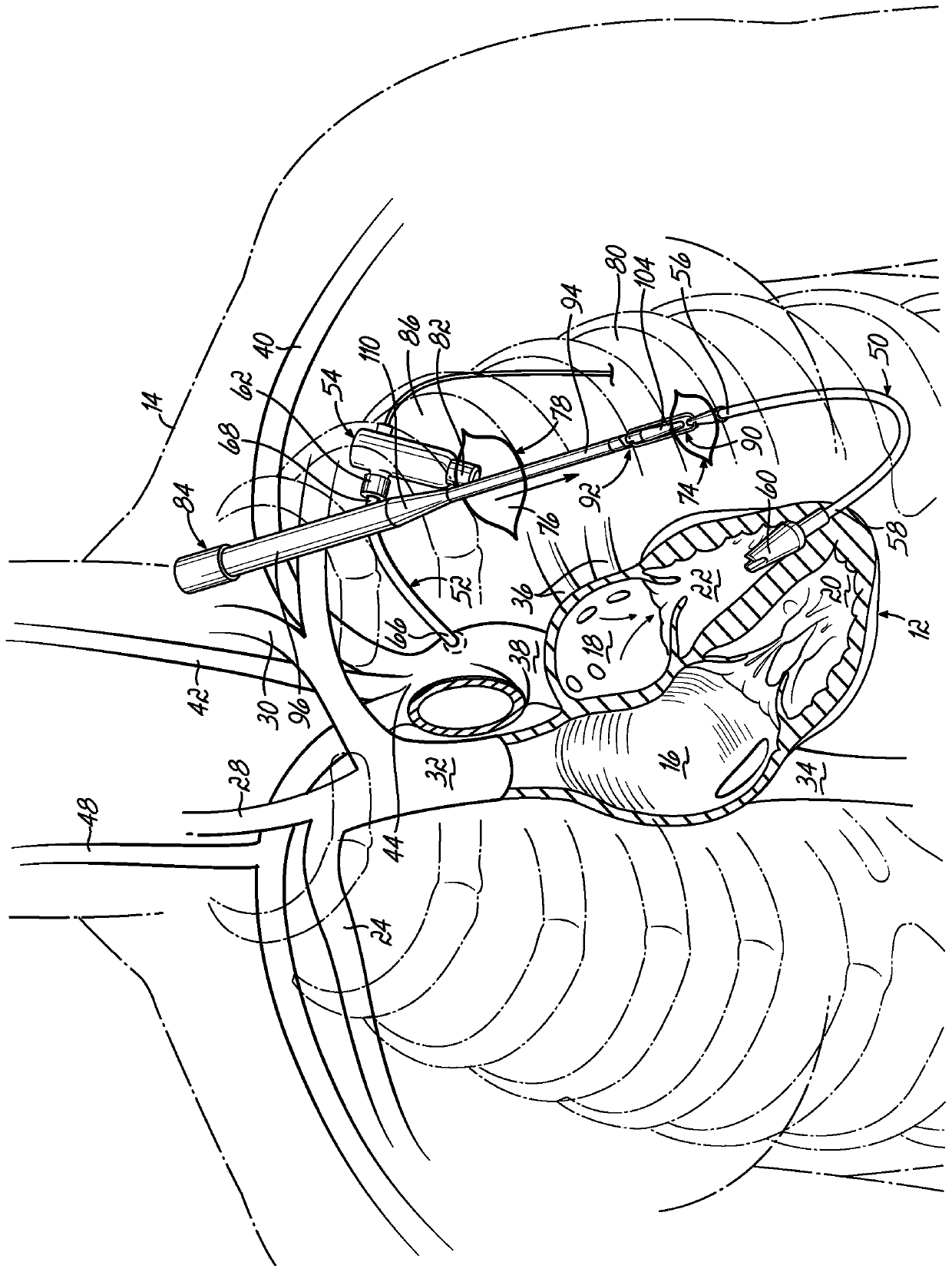 Inflow cannula tunneling tool allowing quick exchange with dilation plug