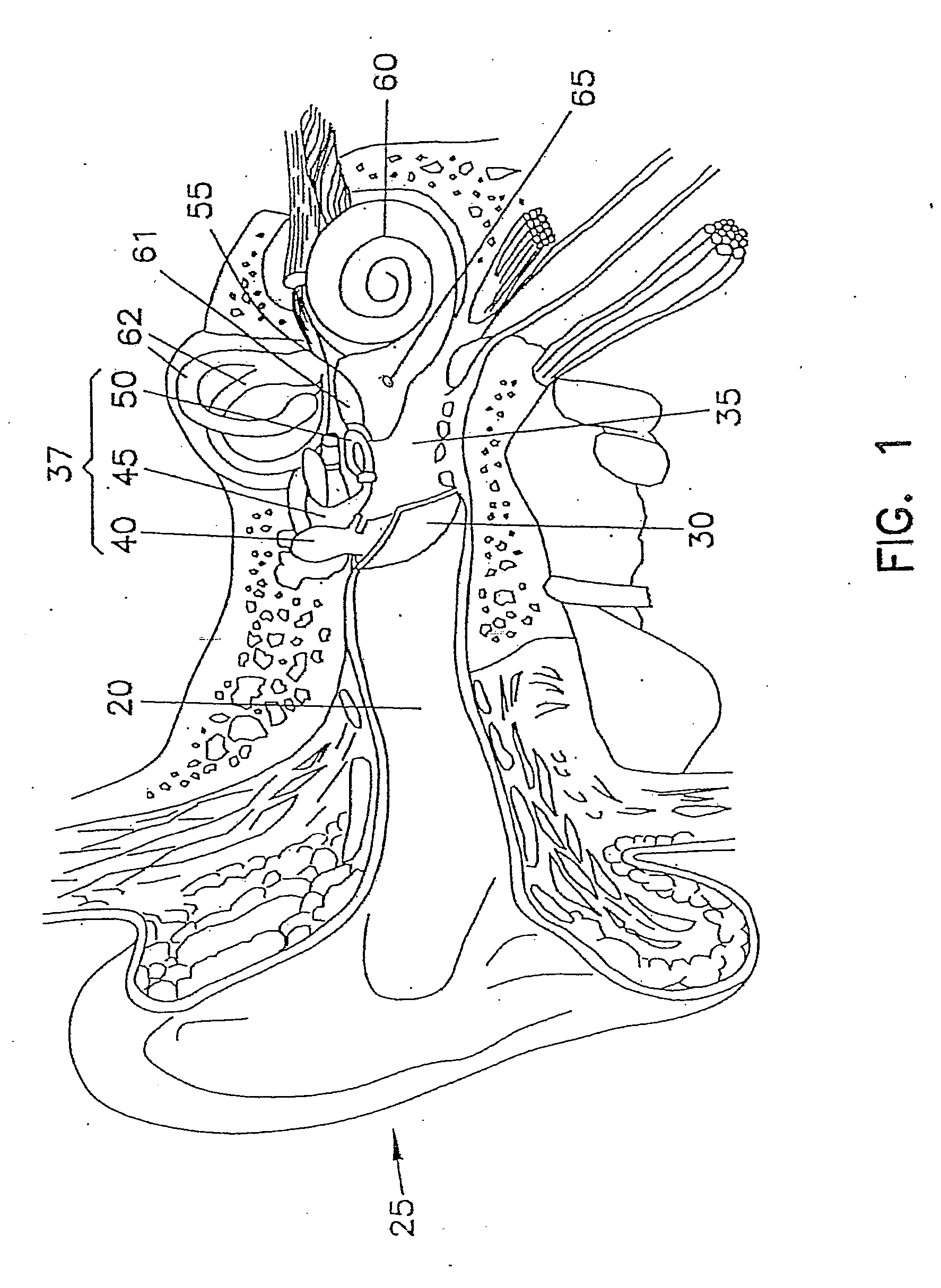 Method and apparatus for vibrational damping of implantable hearing aid components