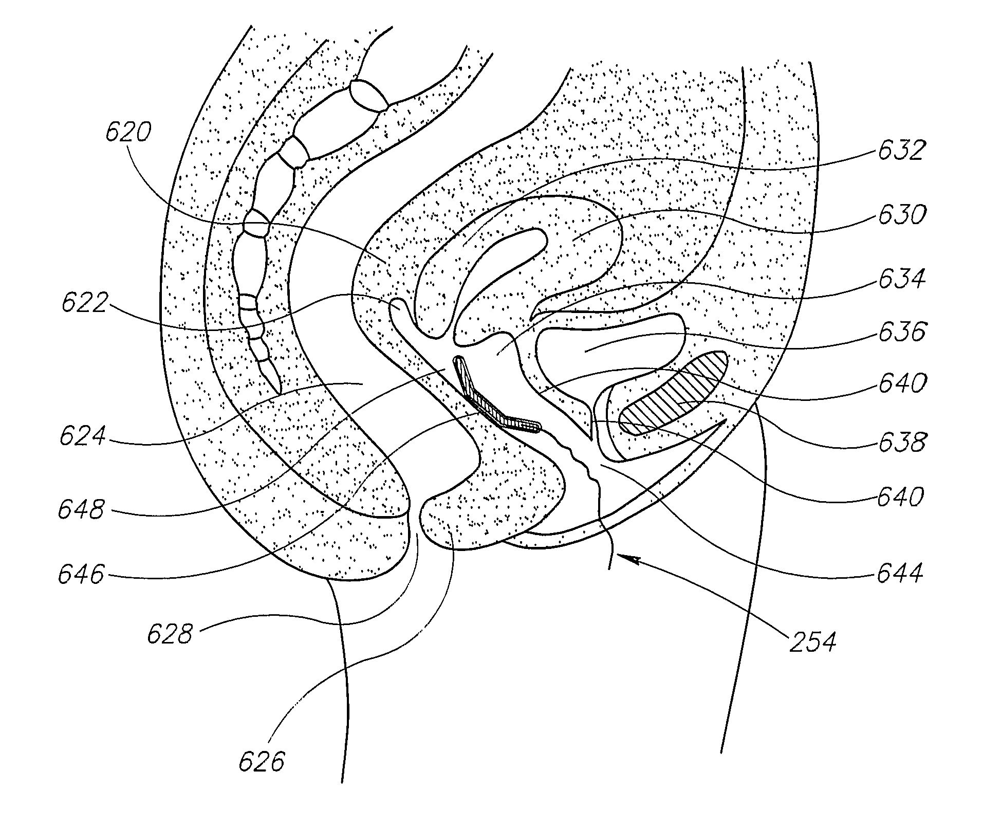 Apparatus For the Treatment of Feminine Pelvic Organ Prolapse