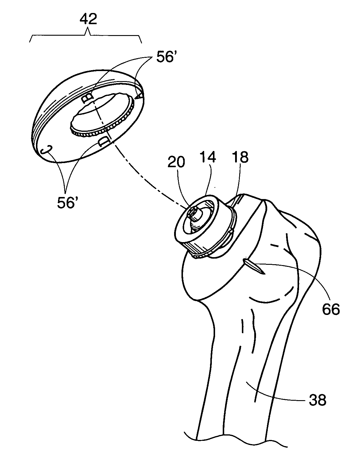 Adjustable bone prostheses and related methods related applications