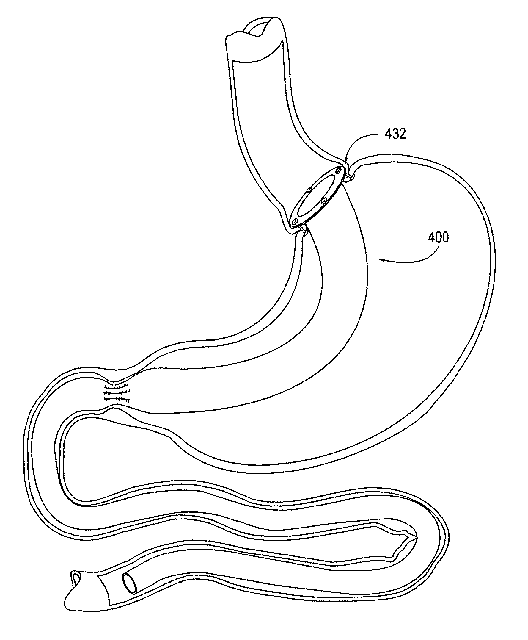 Apparatus and methods for treatment of morbid obesity