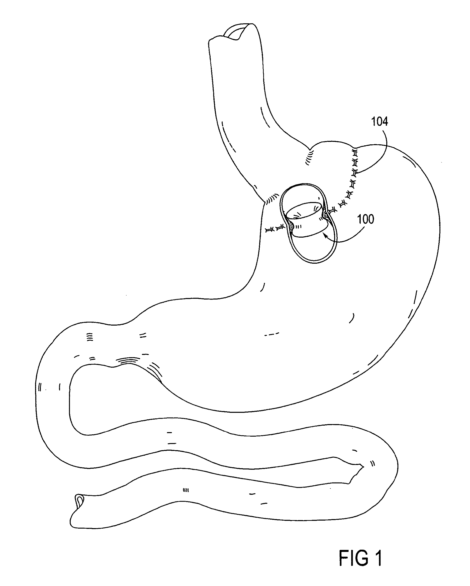 Apparatus and methods for treatment of morbid obesity