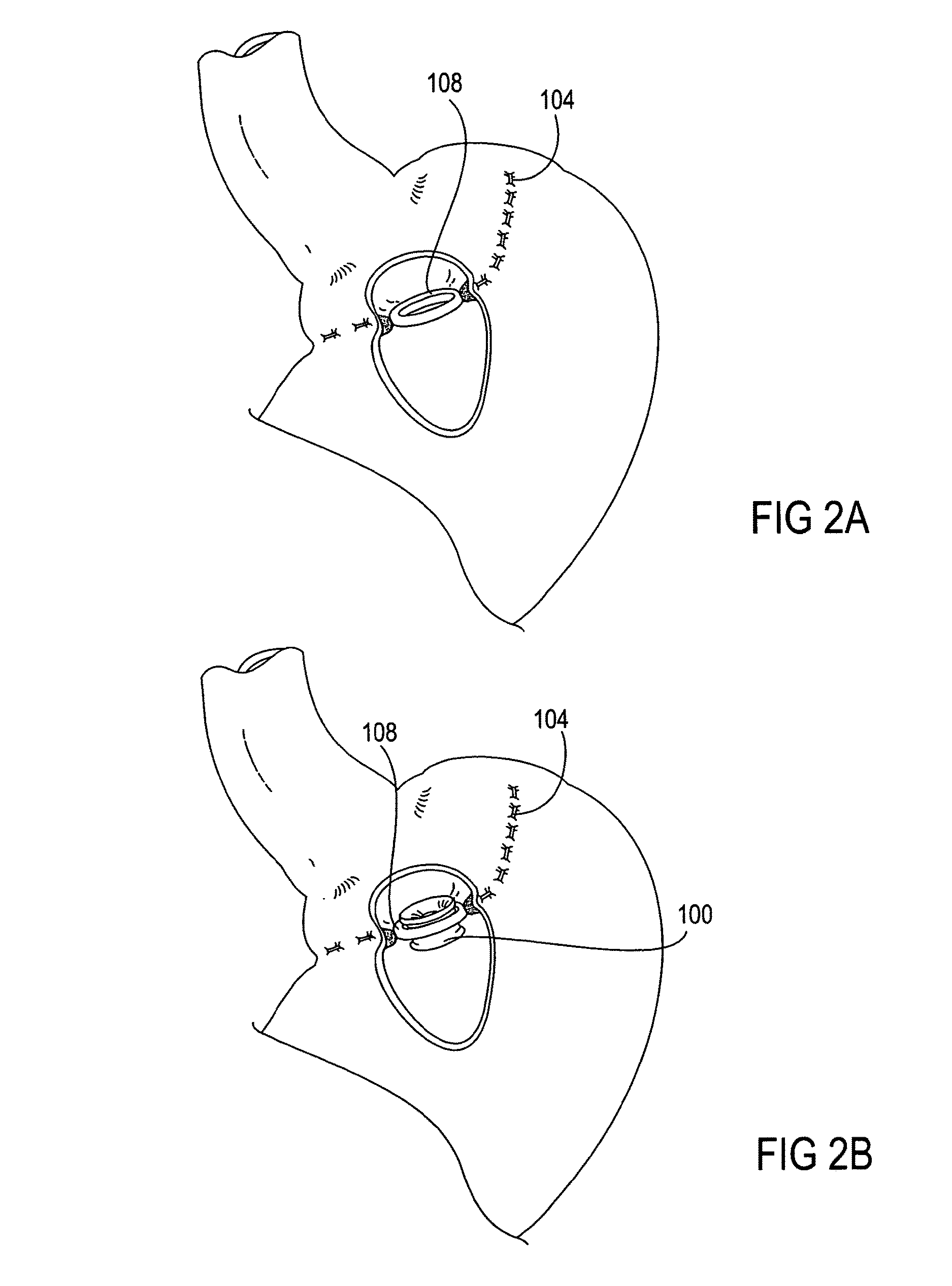 Apparatus and methods for treatment of morbid obesity