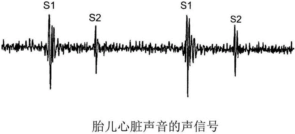 Method and device for determining fetal heart sounds by passive sensing and system for examining fetal heart function