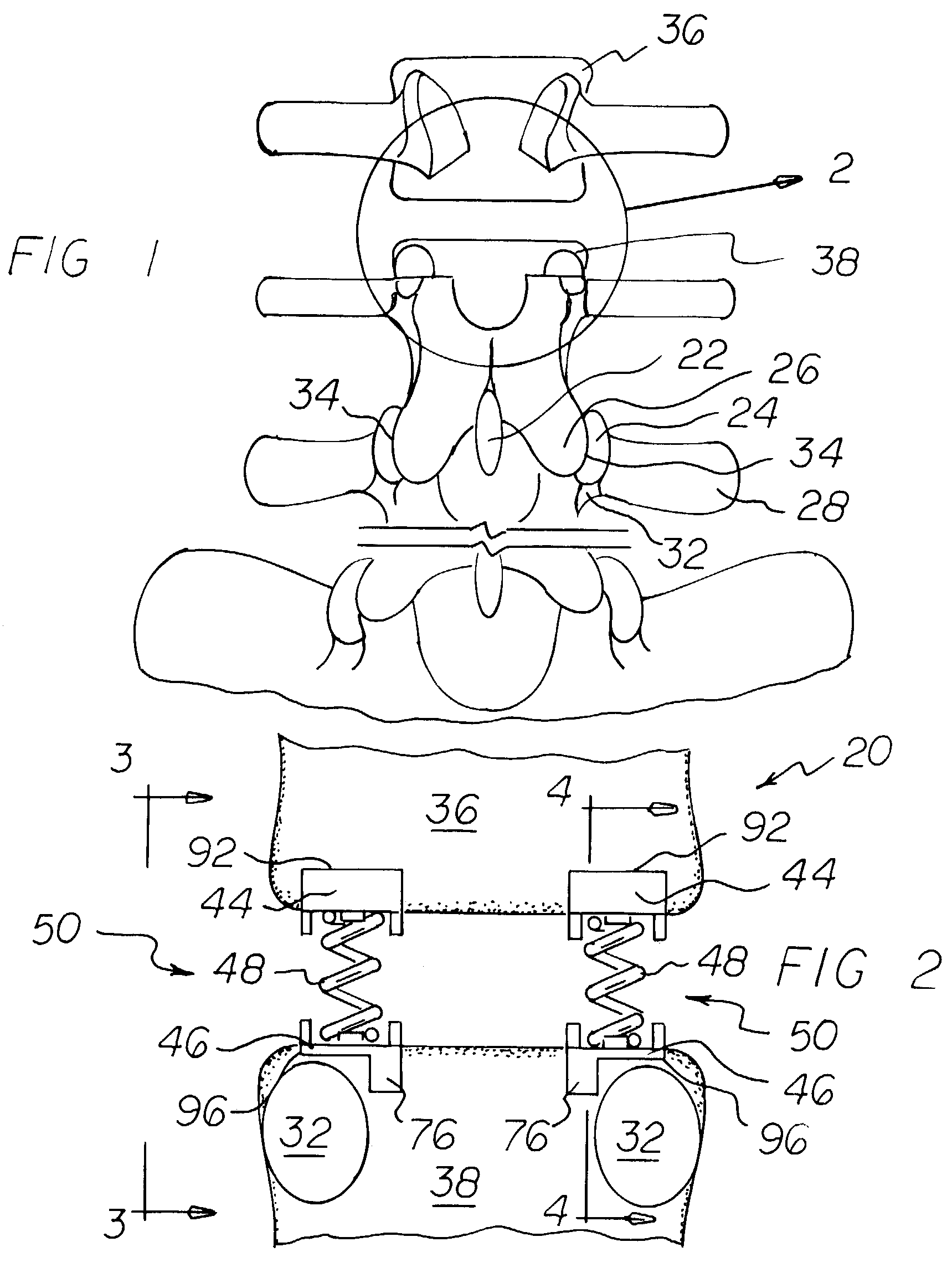 Vertebral implant with dampening matrix adapted for posterior insertion