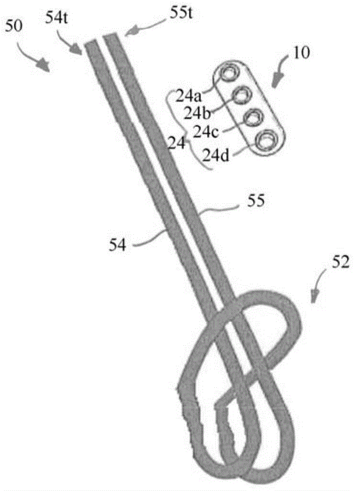 Implant having adjustable filament coils