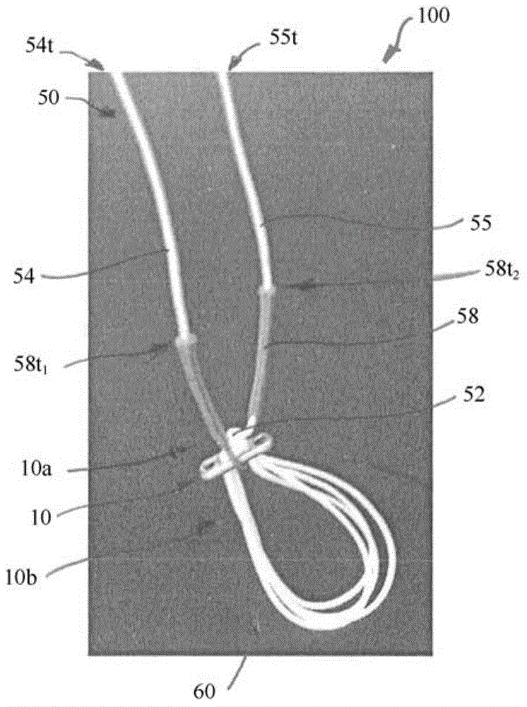 Implant having adjustable filament coils