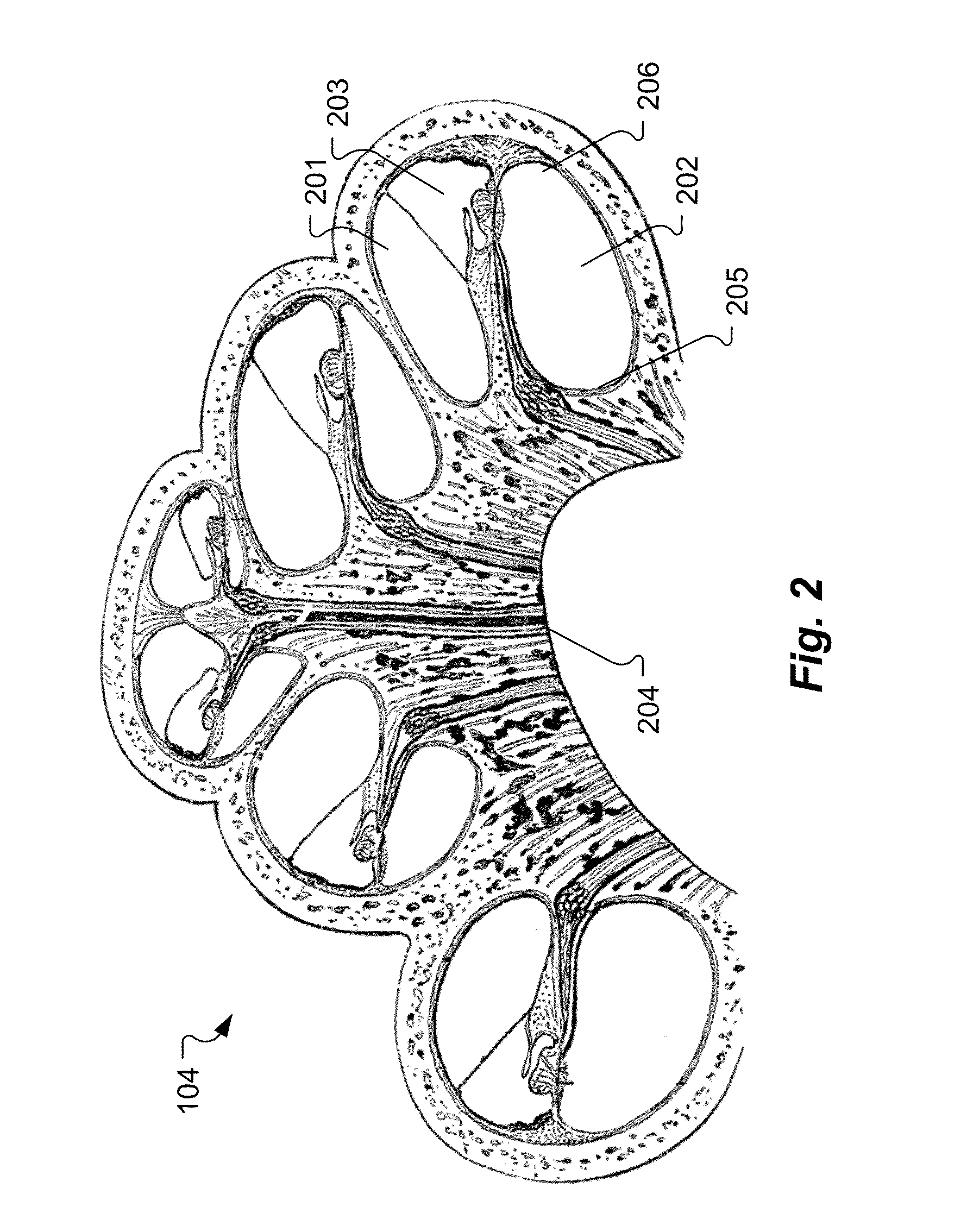 Cochlear Electrode With Apical Lateral Wall Section and Basal Modiolar Hugging Section