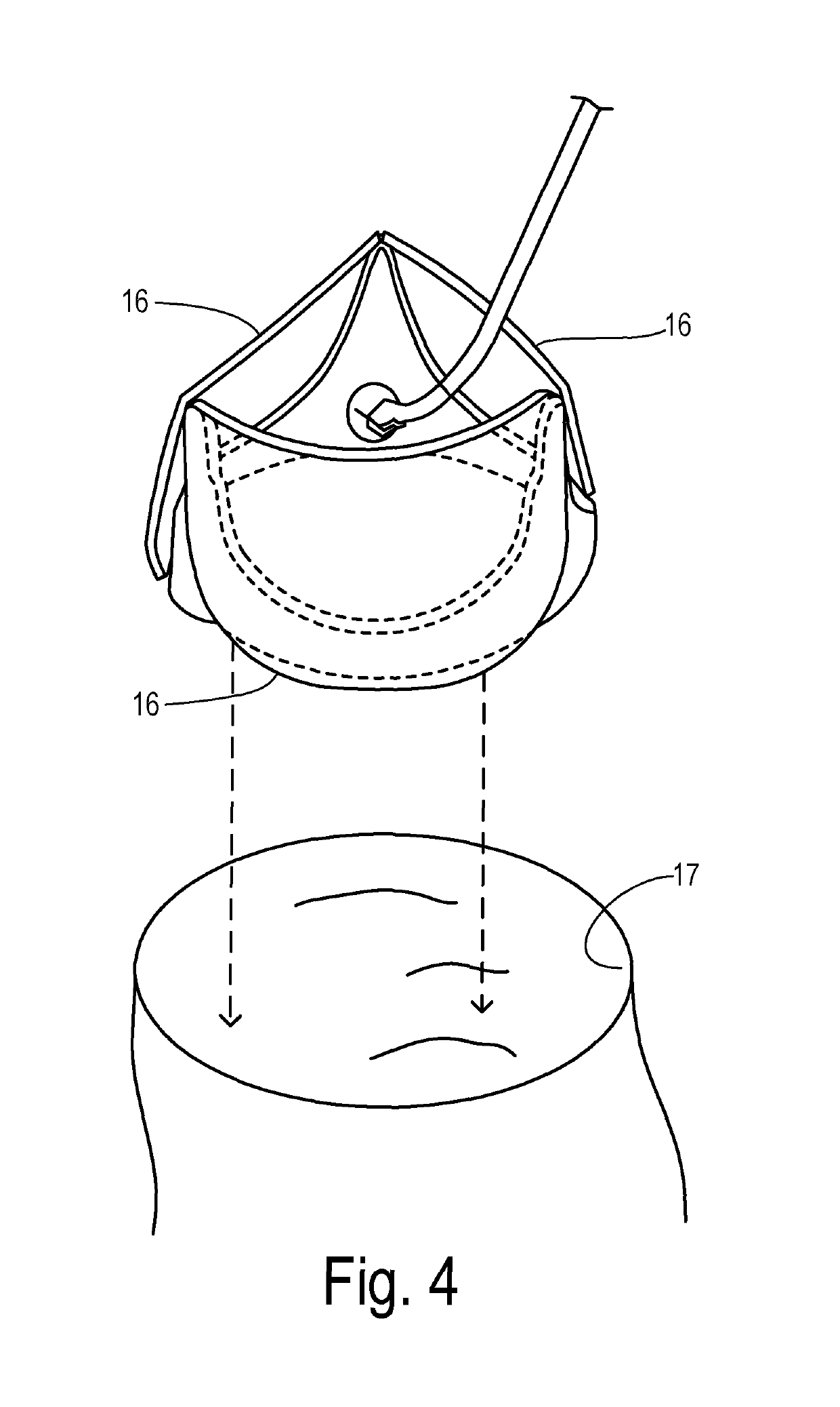 Temporary disposable scaffold stand and tools to facilitate reconstructive valve surgery