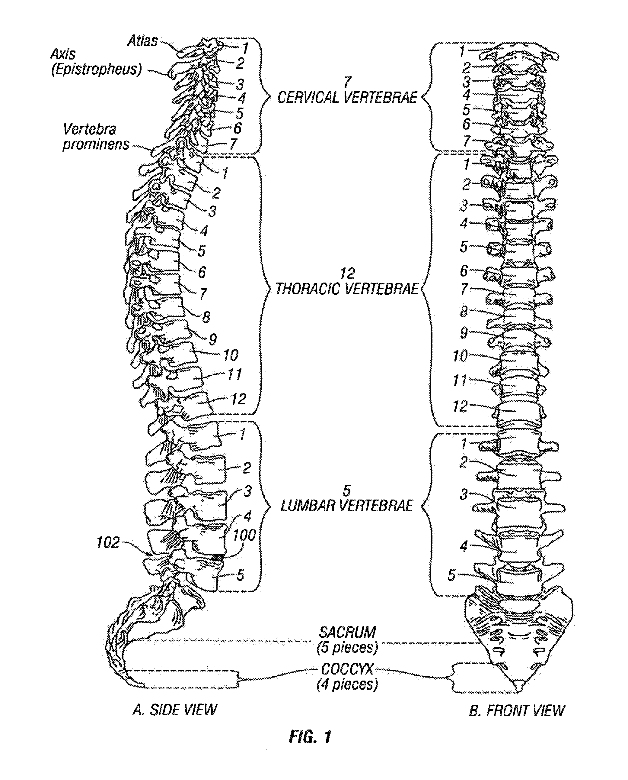 Selectively Expanding Spine Cage, Hydraulically Controllable In Three Dimensions For Enhanced Spinal Fusion