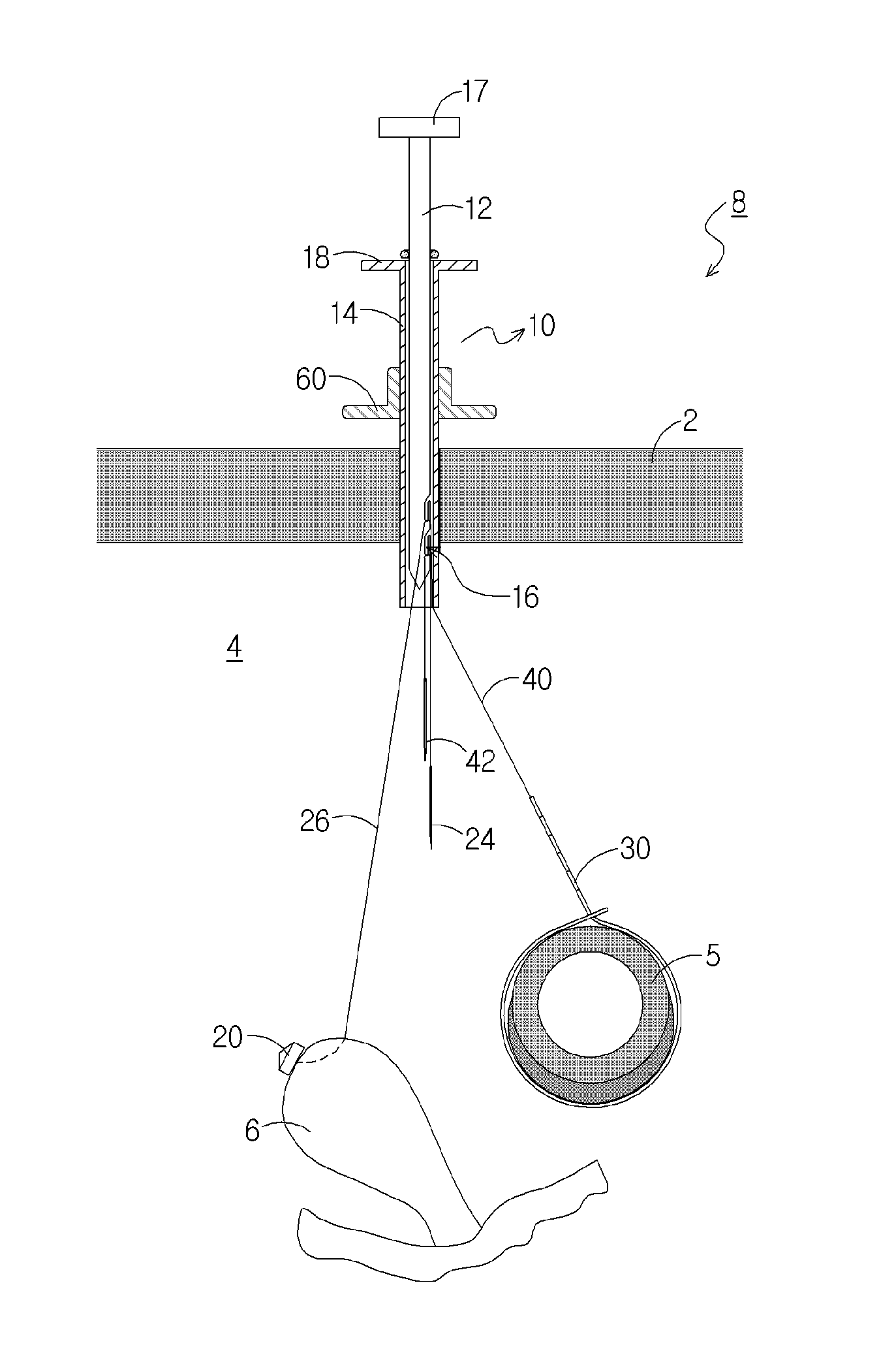 Retraction device for laparoscopy