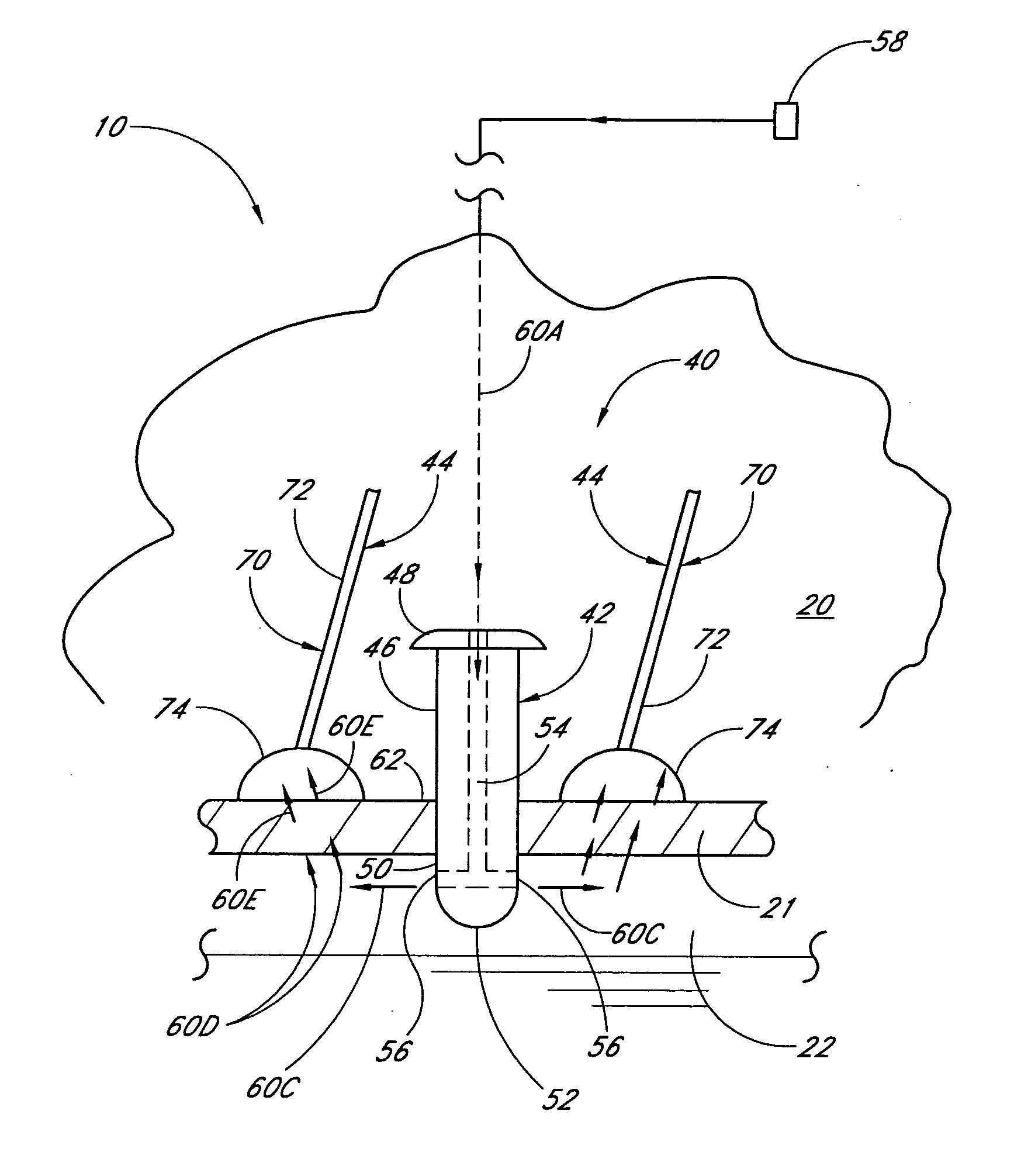 Medical device and methods of use for glaucoma treatment