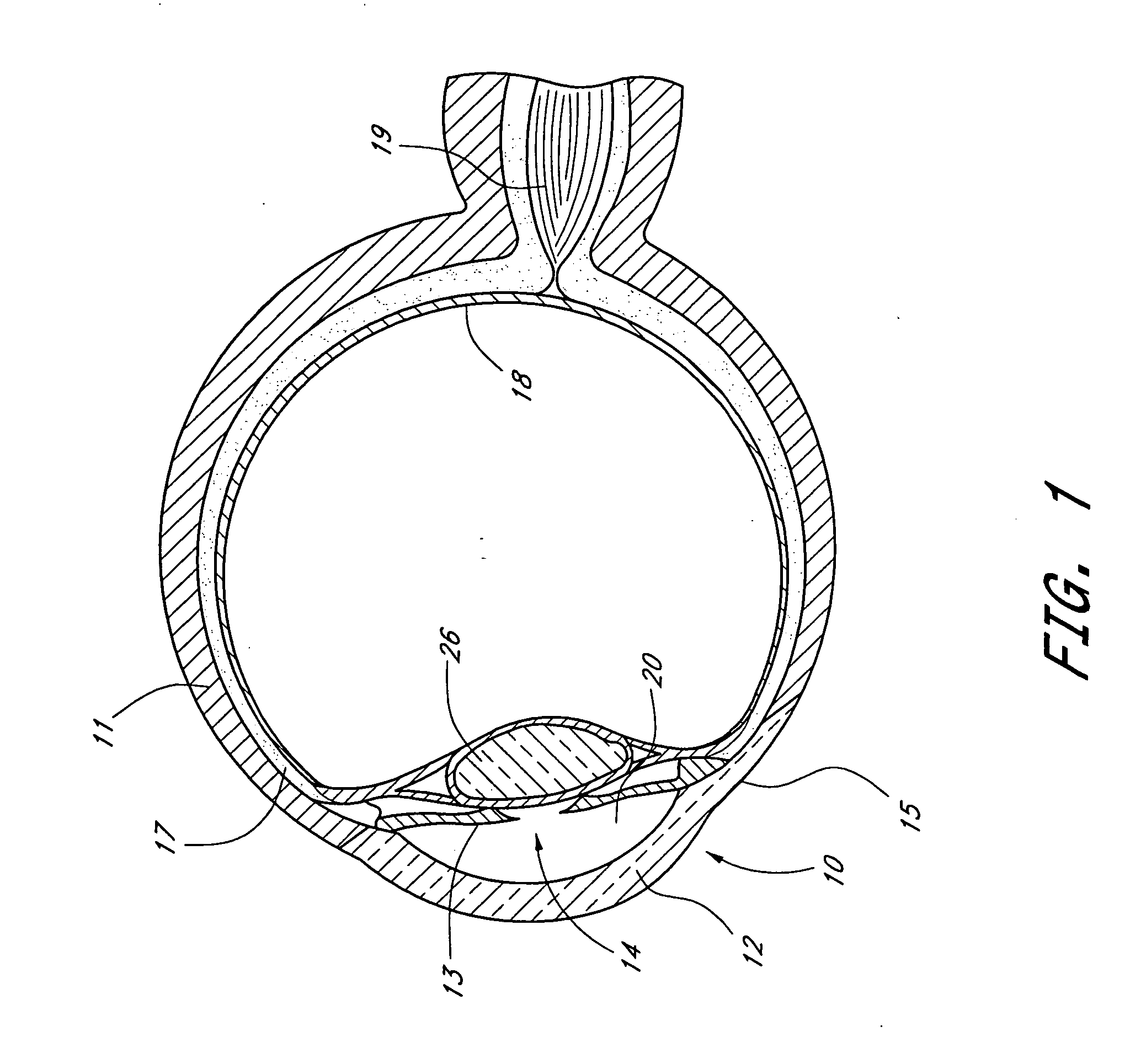 Medical device and methods of use for glaucoma treatment