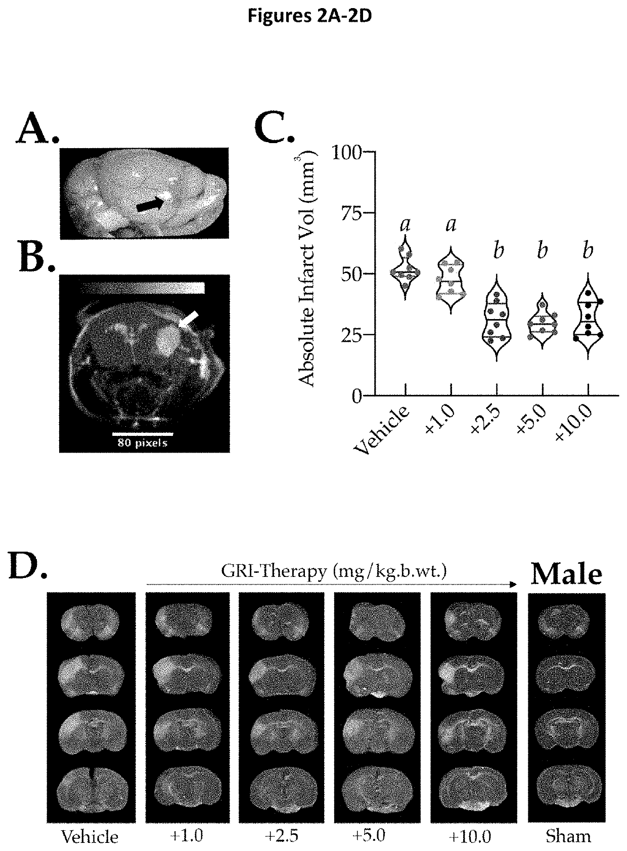 GSNO reductase inhibitor as an adjunct therapy with remote ischemic conditioning and thrombolytic reperfusion therapies in cerebral thrombosis and/or thromboembolic stroke