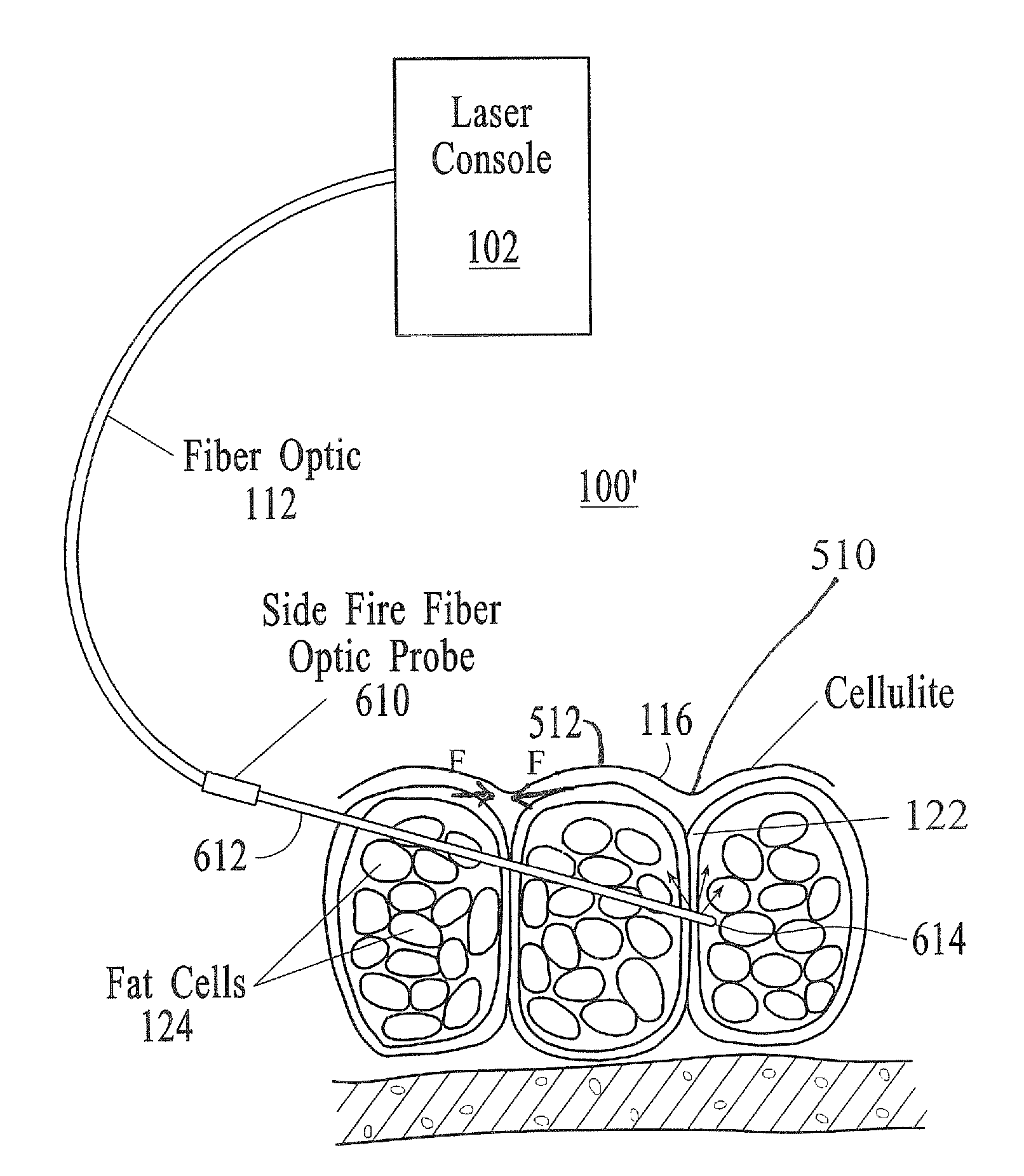 Treatment of cellulite and adipose tissue with mid-infrared radiation