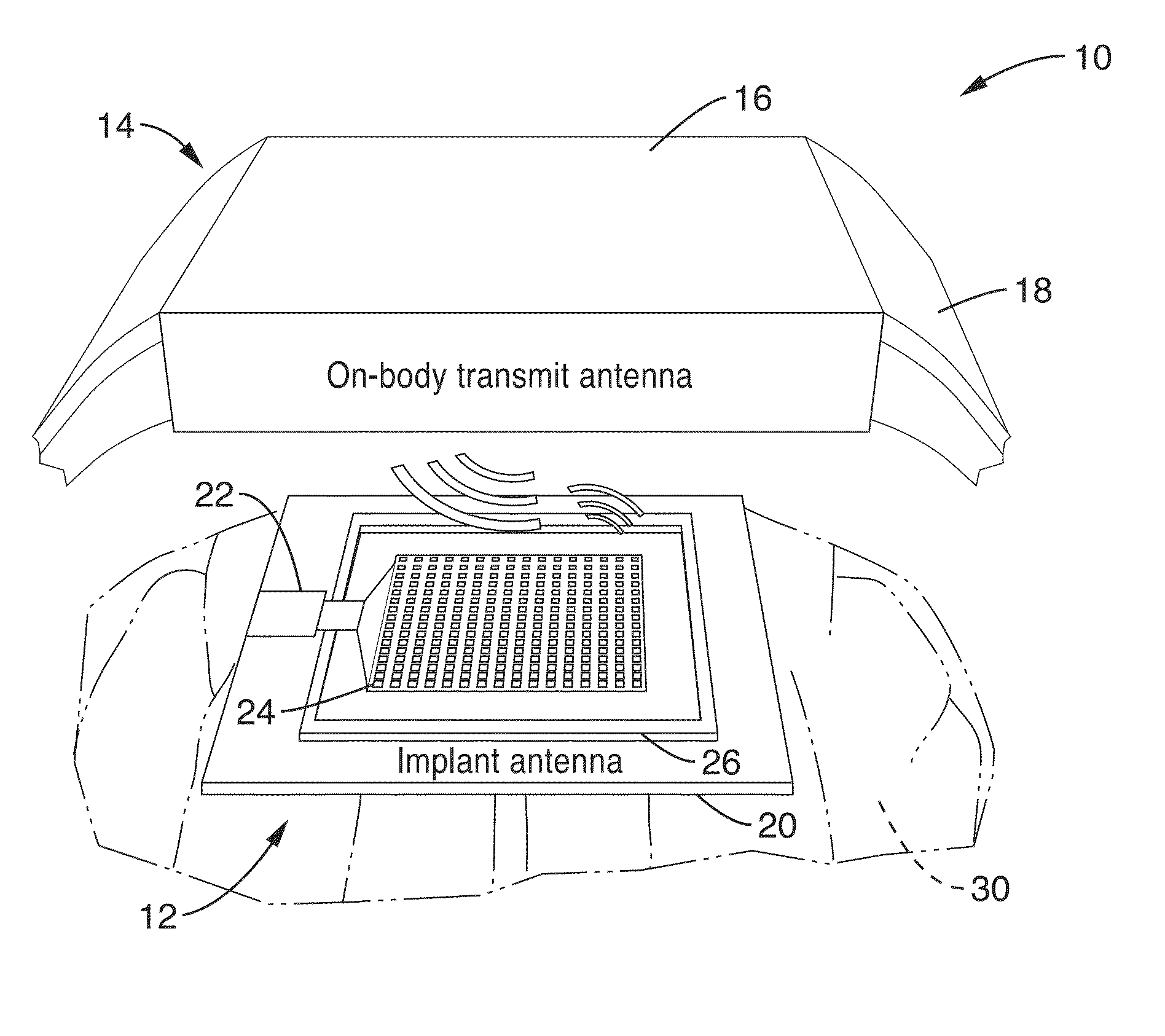 Monolithically integrated implantable flexible antenna for electrocorticography and related biotelemetry devices