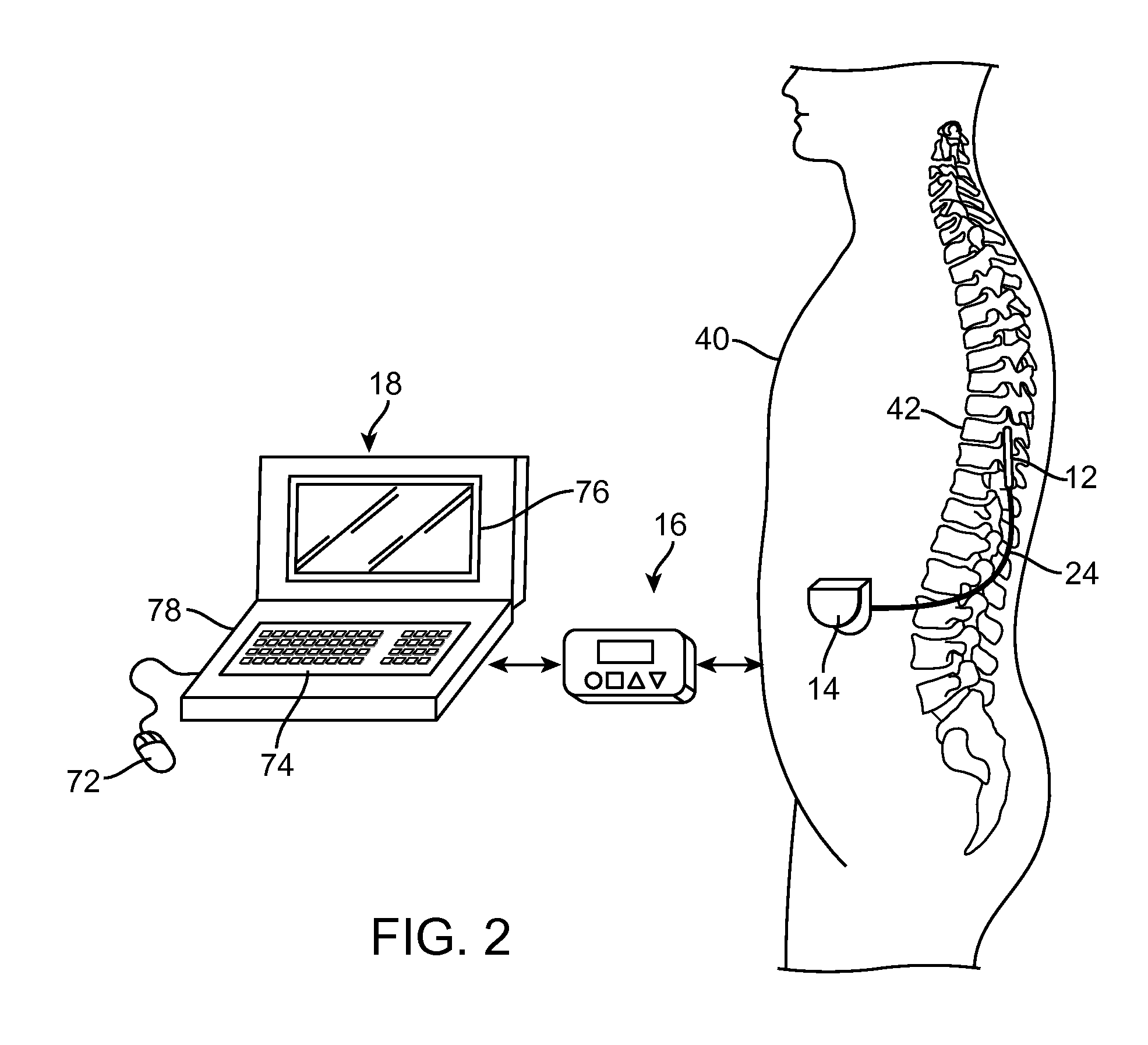 Neurostimulation system for implementing model-based estimate of neurostimulation effects