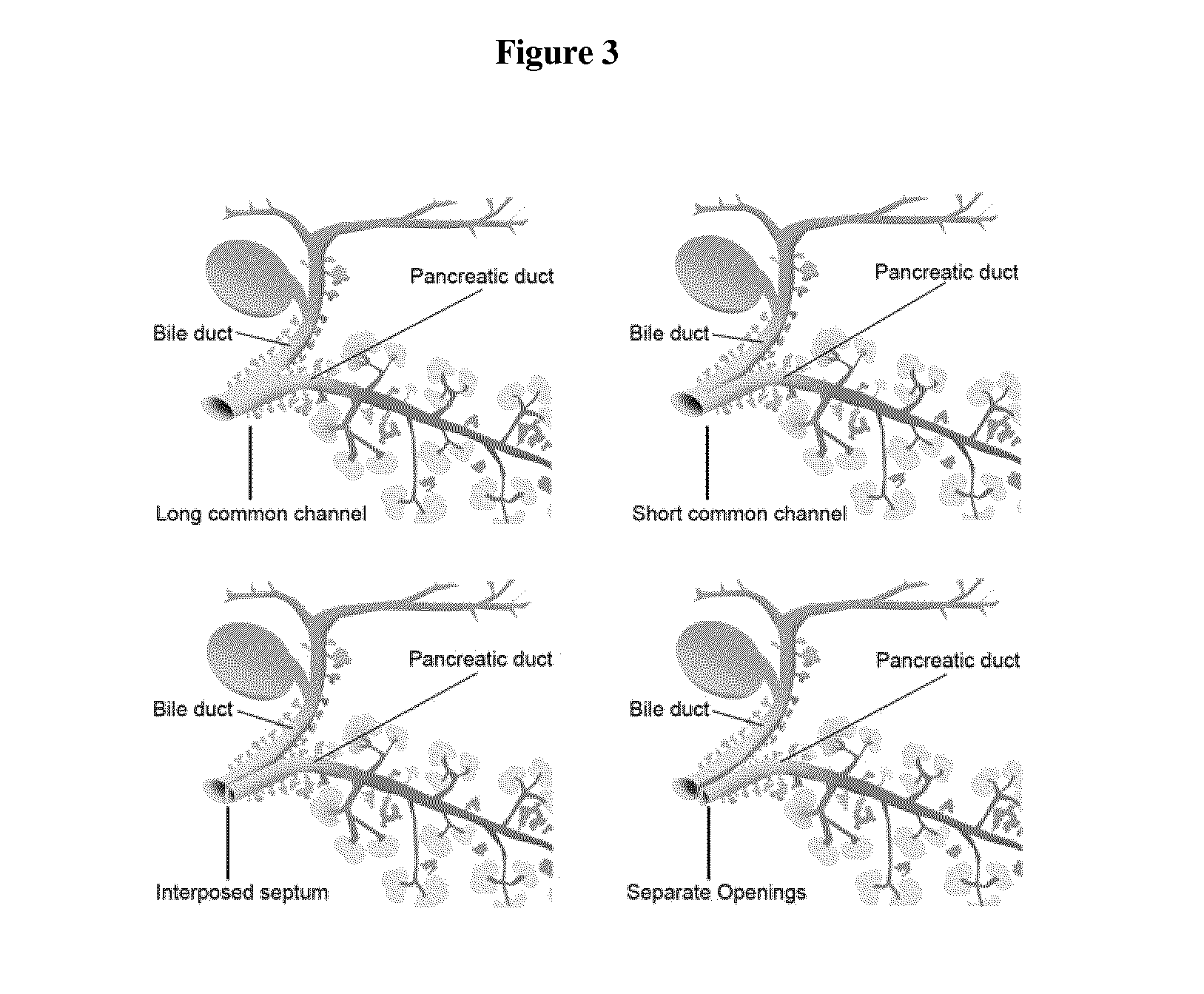 Method of treating pancreatic and liver conditions by endoscopic-mediated (or laparoscopic-mediated) transplantation of stem cells into/onto bile duct walls of particular regions of the biliary tree