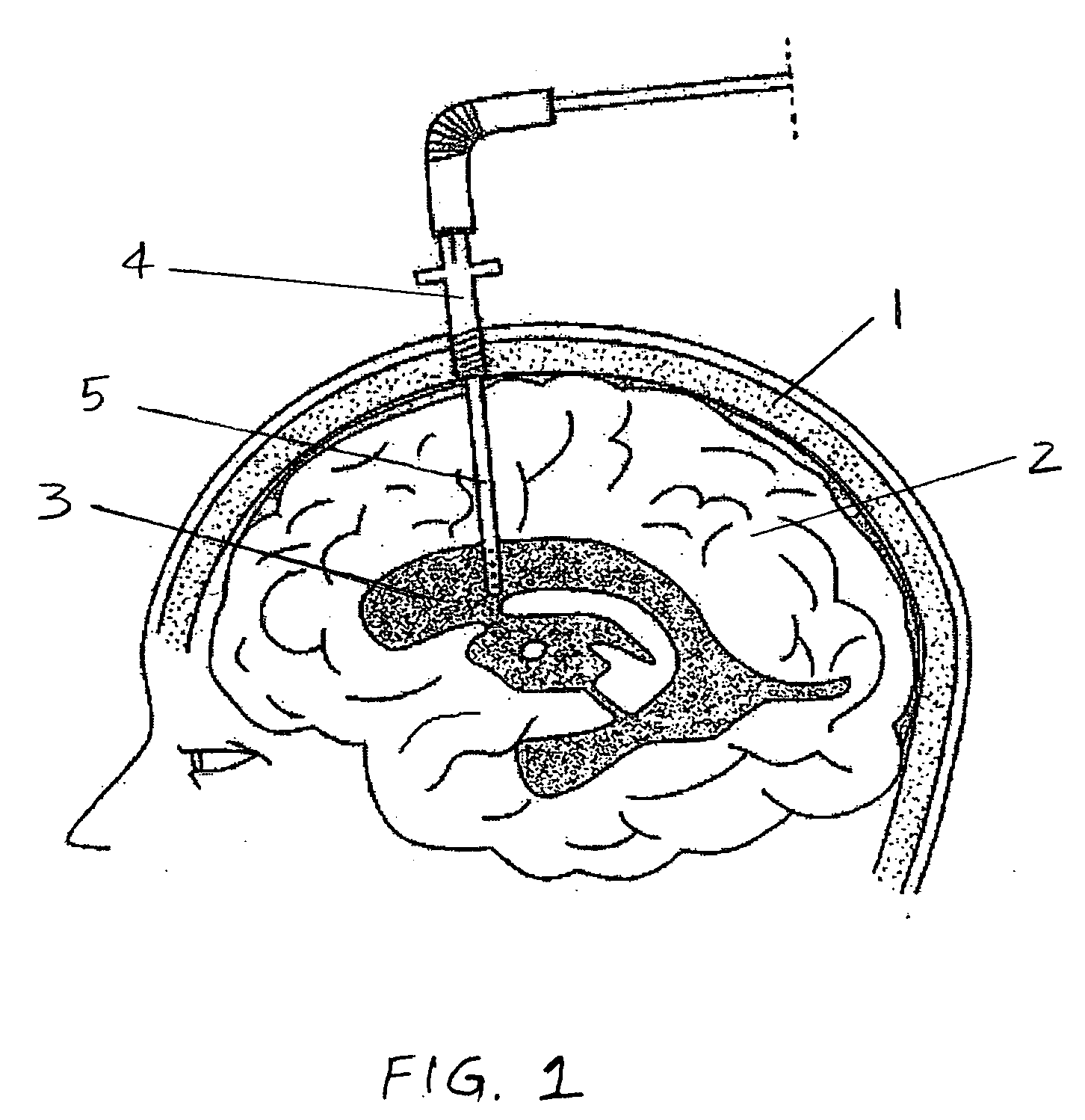 Central nervous system ultrasonic drain