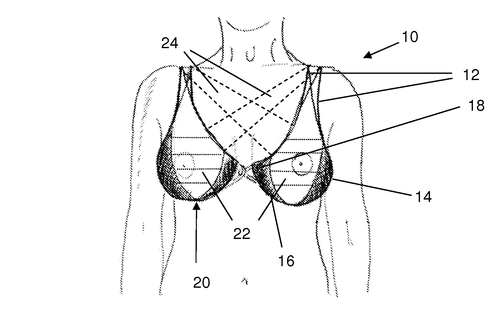 Breast support system for recumbent woman