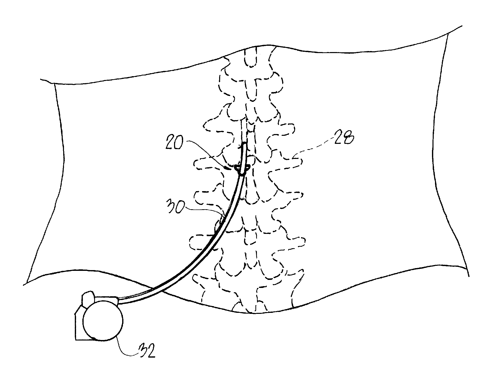 Spinal cord stimulator lead anchor