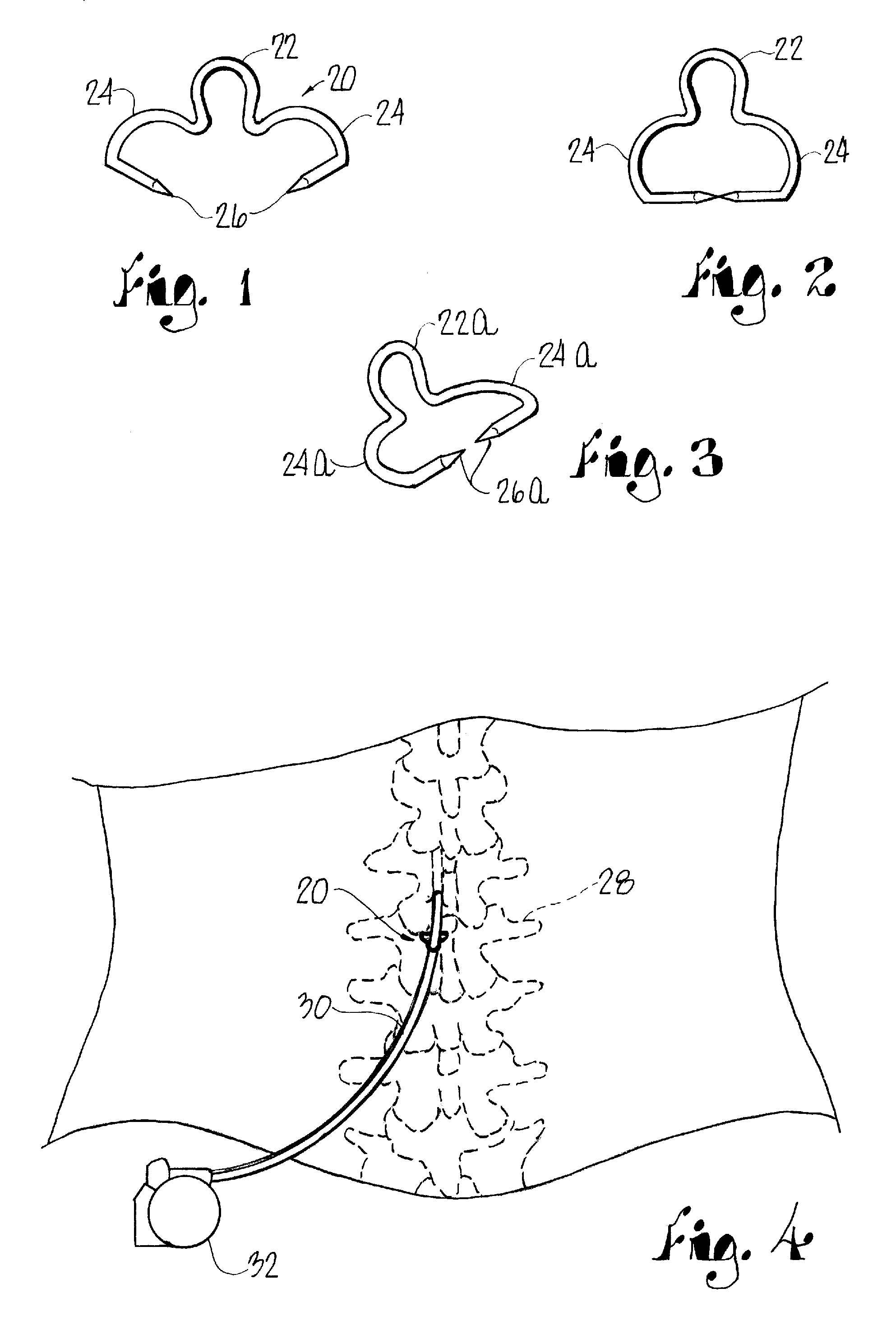 Spinal cord stimulator lead anchor