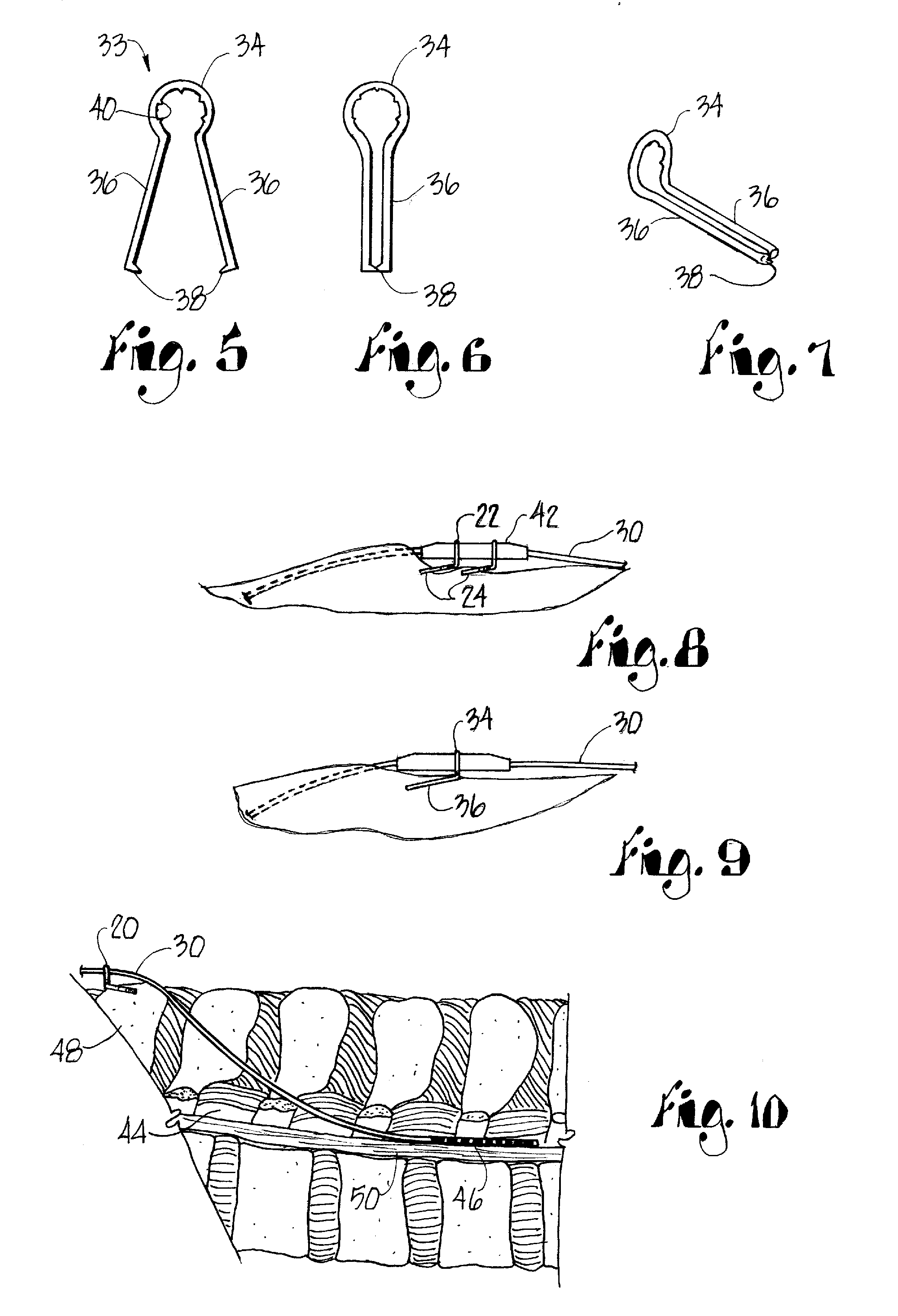 Spinal cord stimulator lead anchor